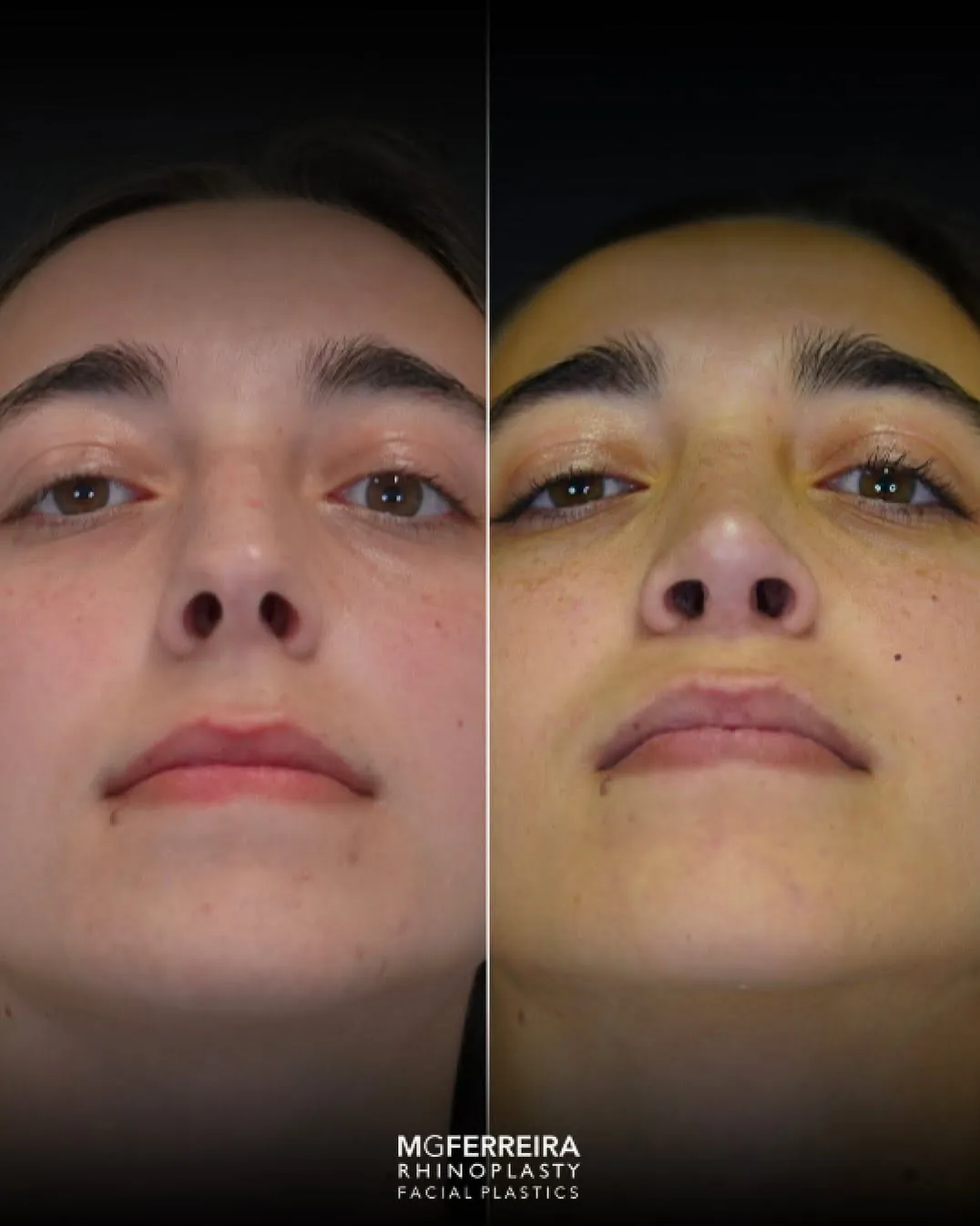 Rinoplastia em nariz curto: equilíbrio do dorso e da ponta, vista inferior