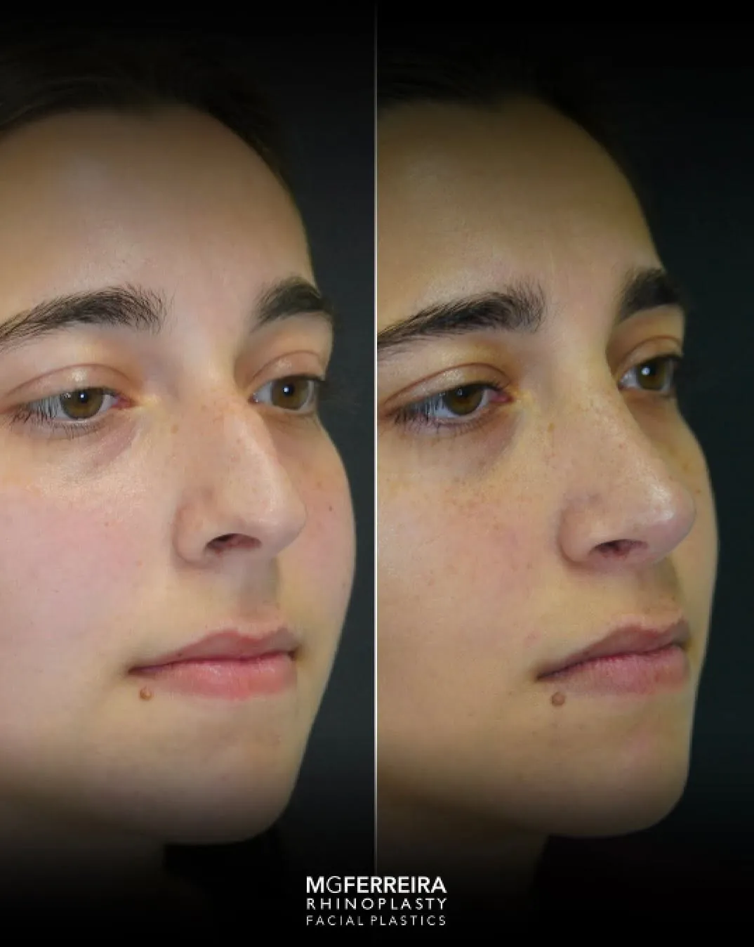 Rinoplastia em nariz curto: equilíbrio do dorso e da ponta, vista oblíqua