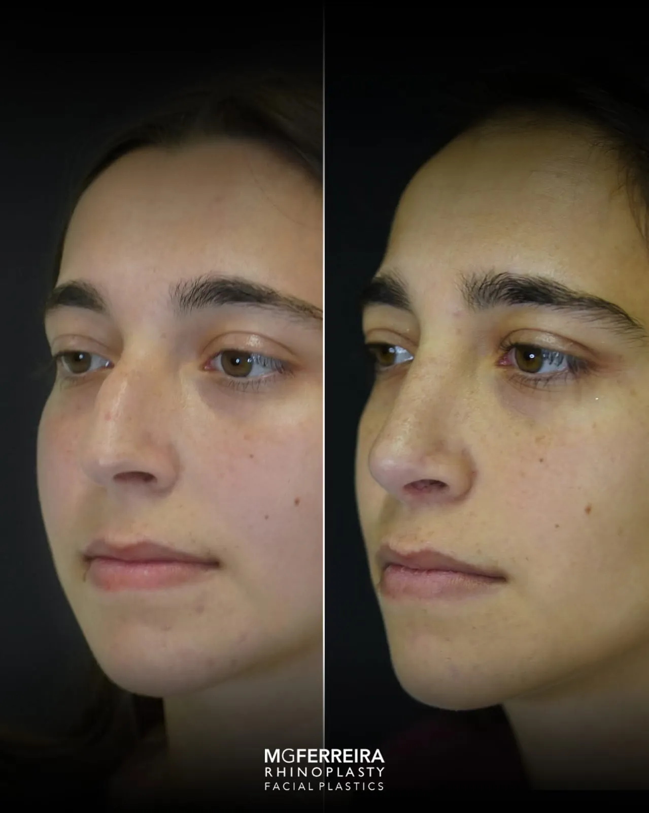 Rinoplastia em nariz curto: equilíbrio do dorso e da ponta, vista oblíqua oposta