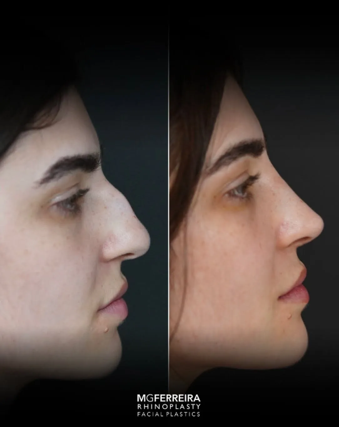 Rinoplastia em nariz longo com giba, perfil