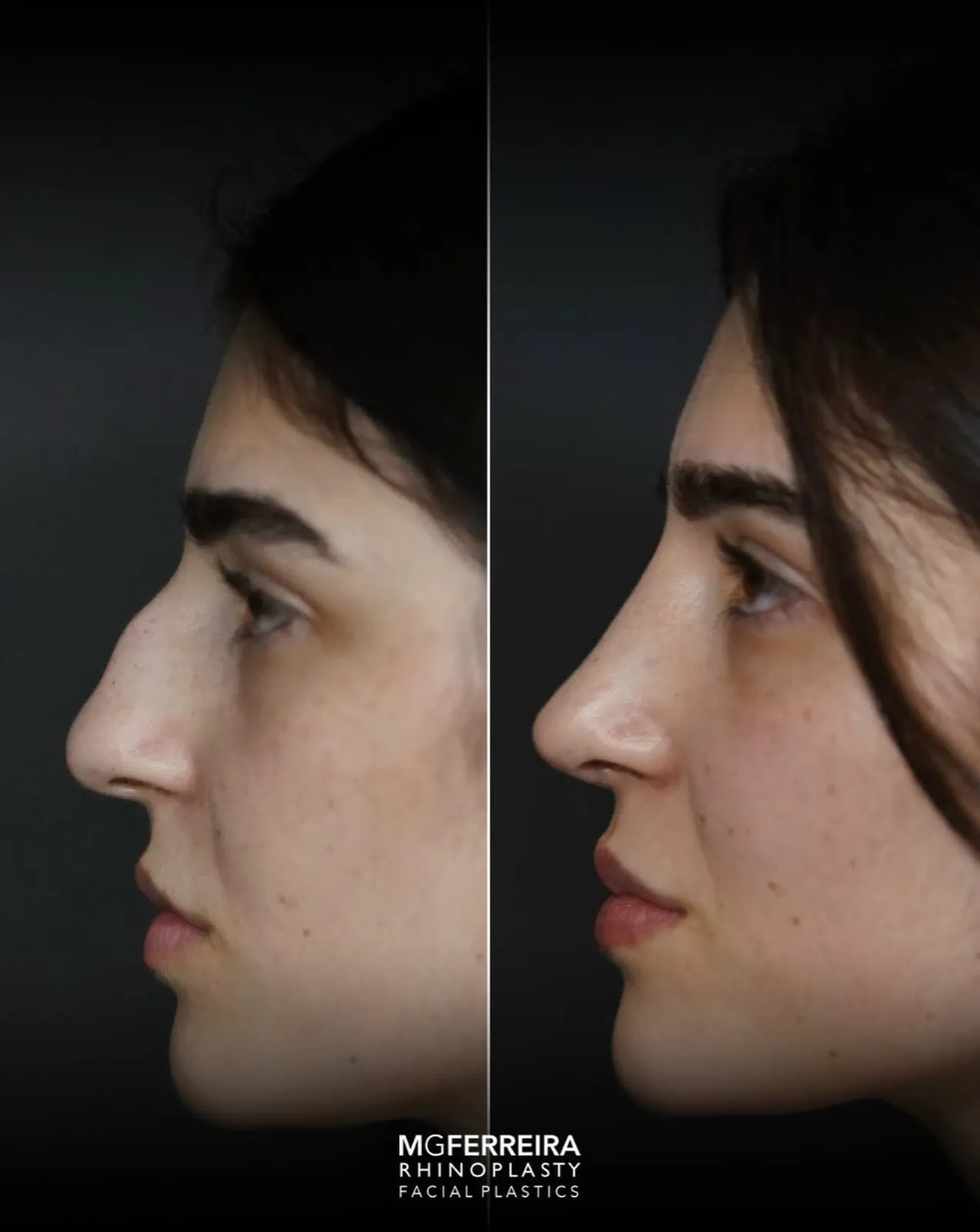 Rinoplastia em nariz longo com giba, perfil oposto