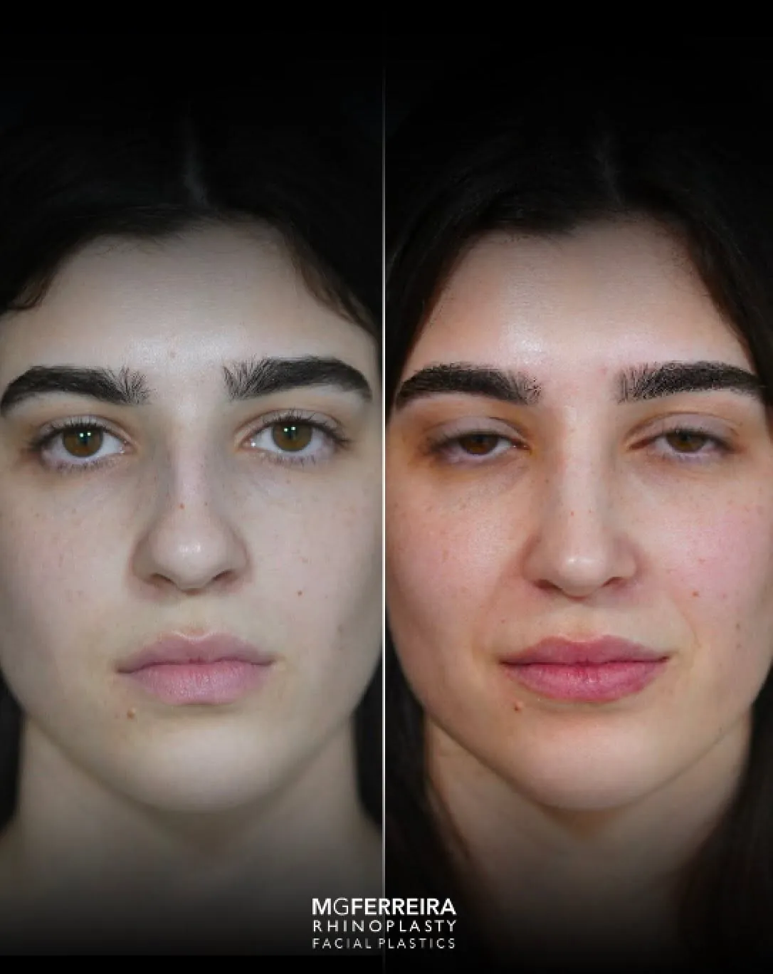 Rinoplastia em nariz longo com giba, vista frontal