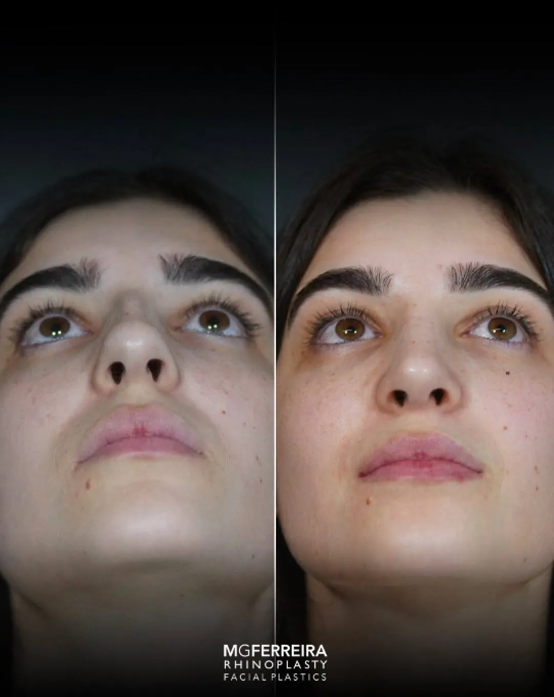 Rinoplastia em nariz longo com giba, vista inferior