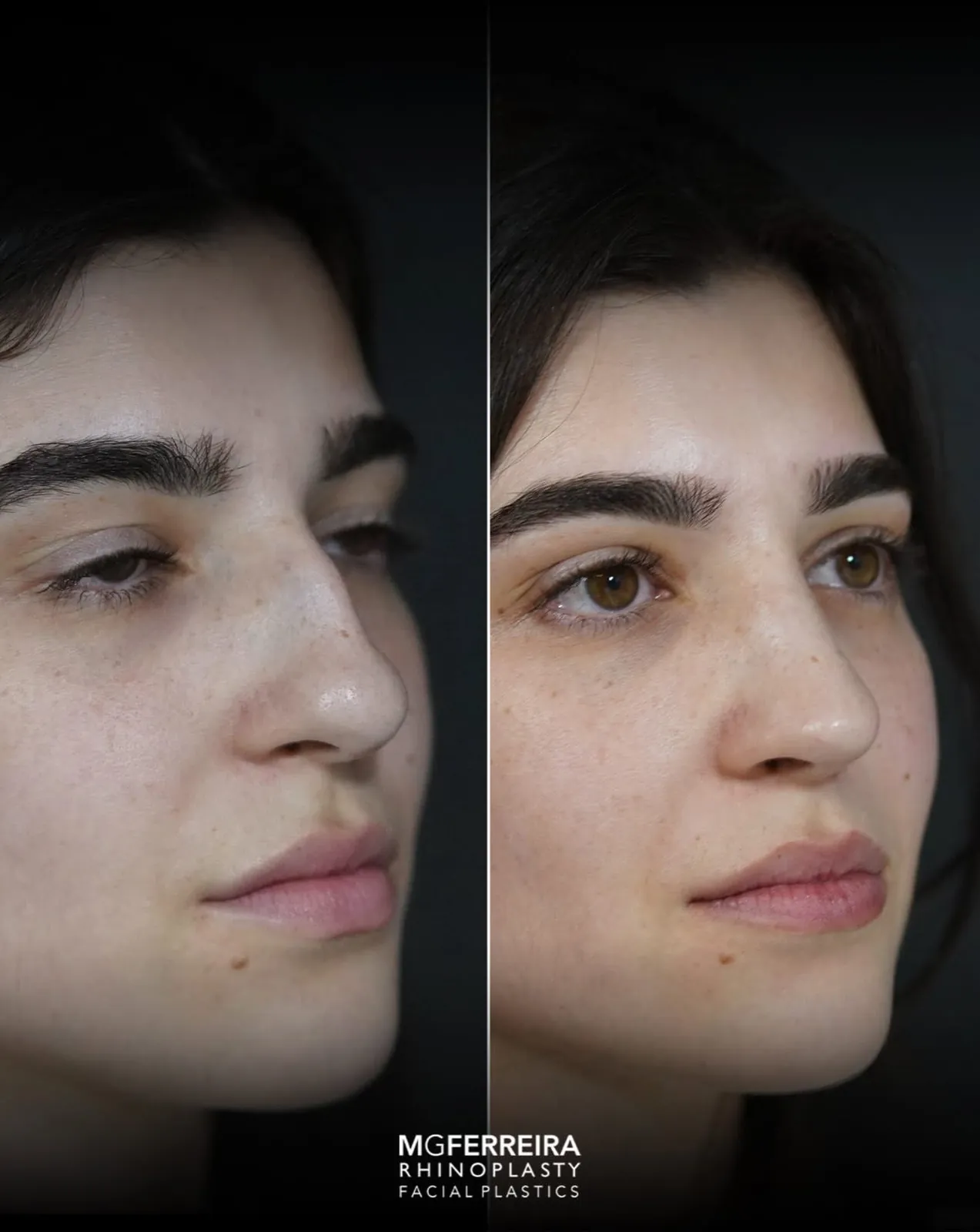 Rinoplastia em nariz longo com giba, vista oblíqua