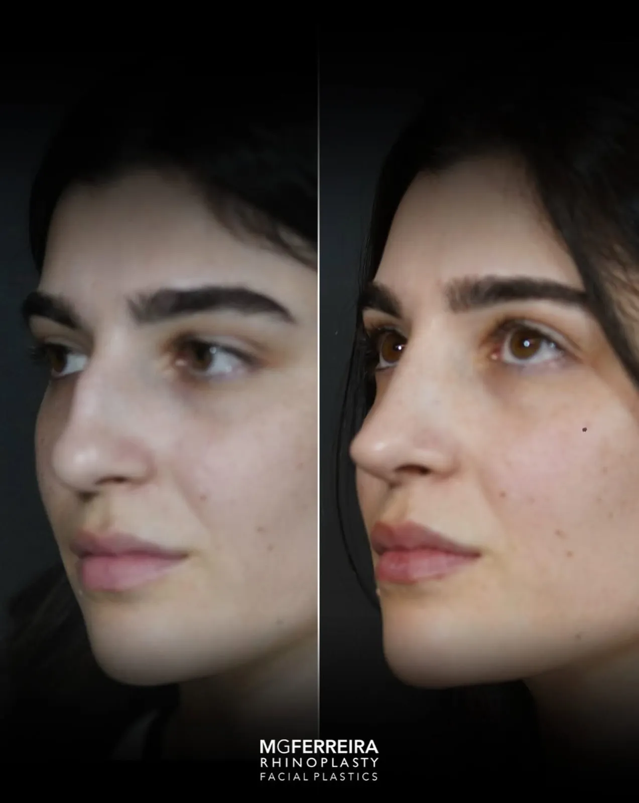 Rinoplastia em nariz longo com giba, vista oblíqua oposta