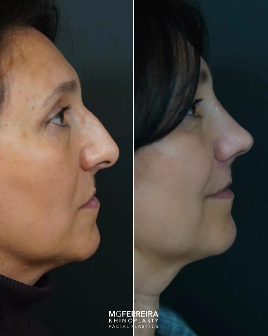 Antes e depois de rinoplastia em paciente com fissura, perfil direito