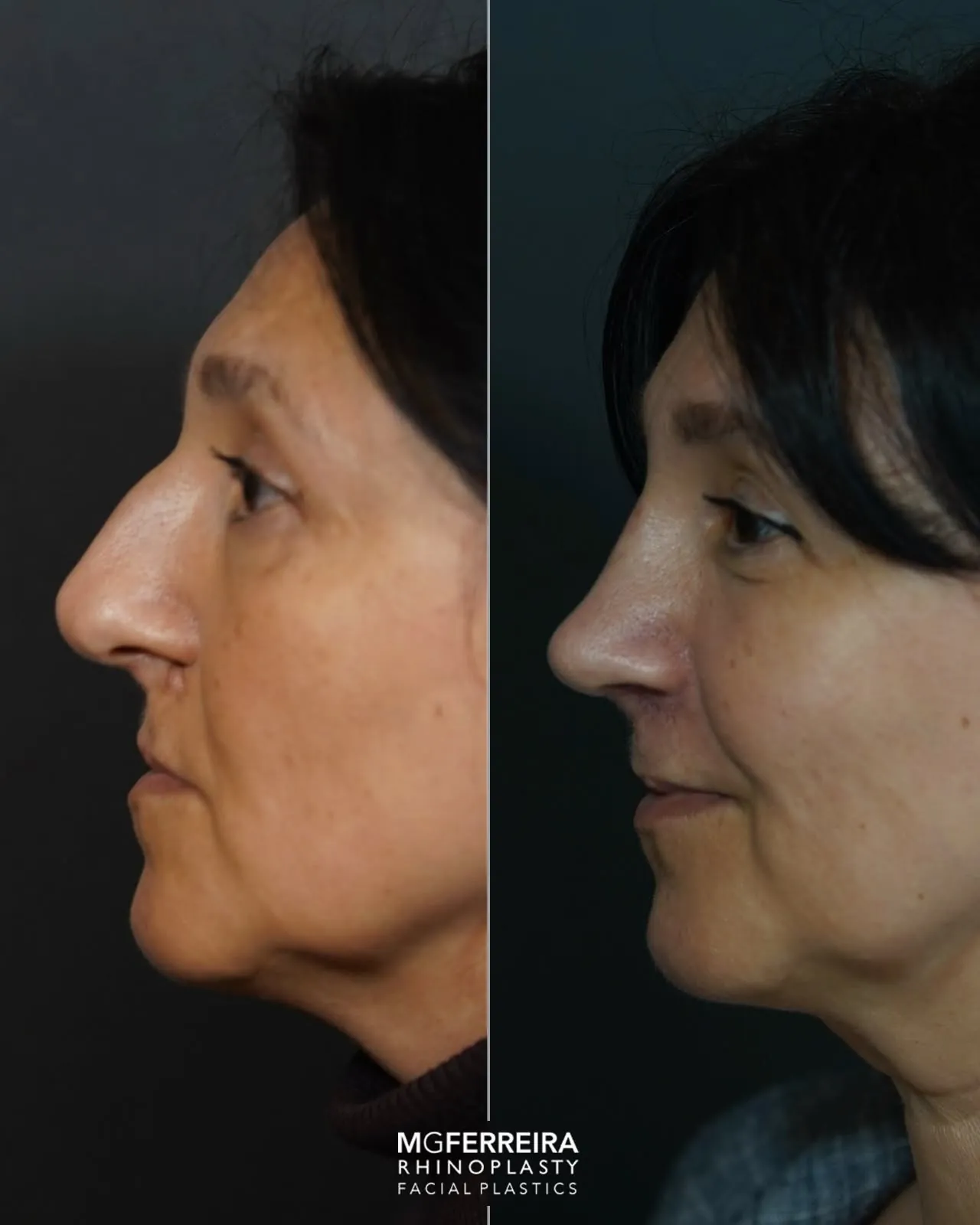 Antes e depois de rinoplastia em paciente com fissura, perfil esquerdo
