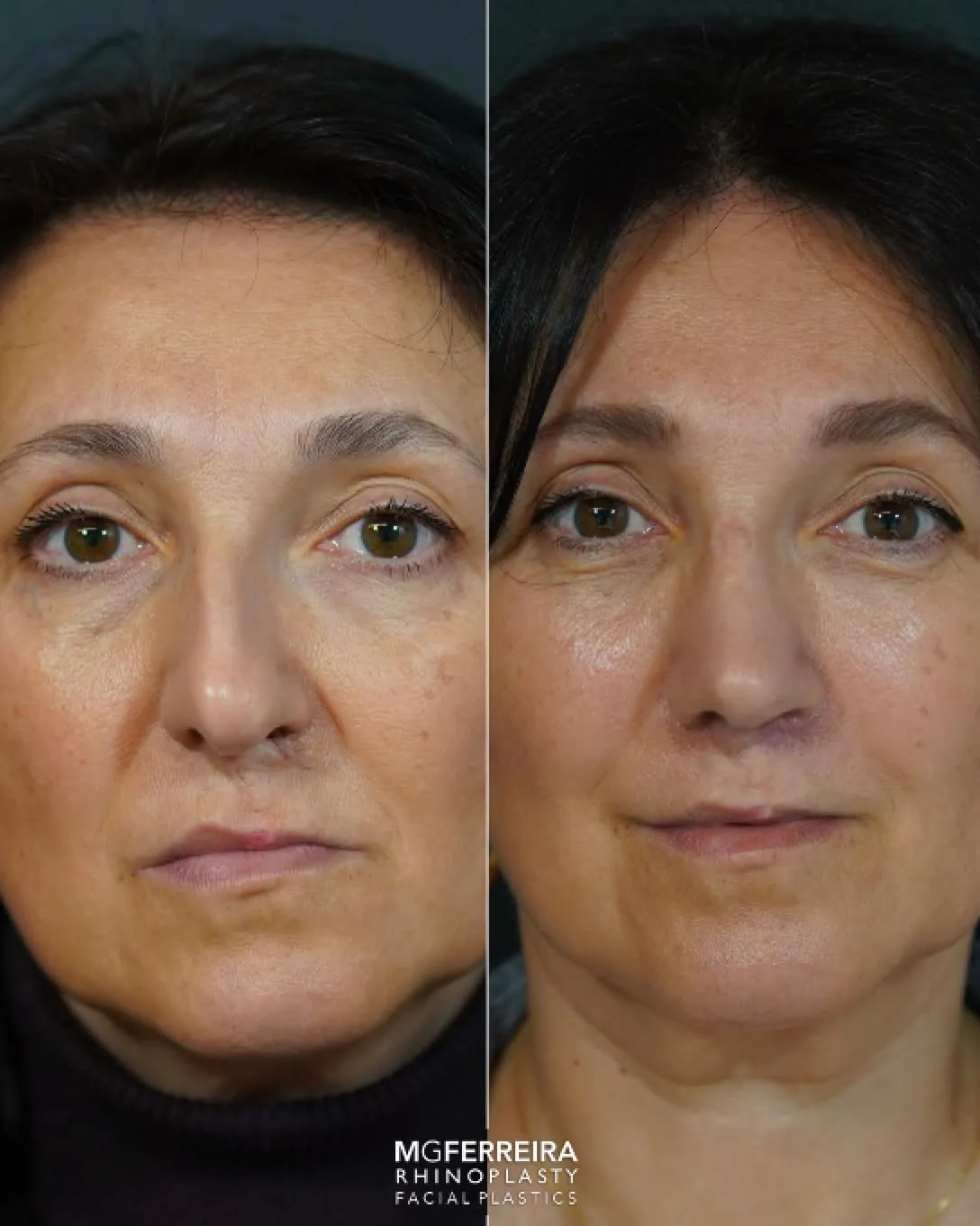 Antes e depois de rinoplastia em paciente com fissura, vista frontal