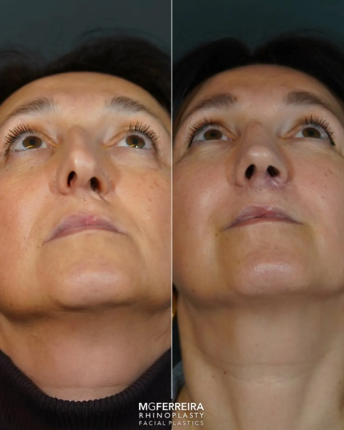 Antes e depois de rinoplastia em paciente com fissura, vista inferior