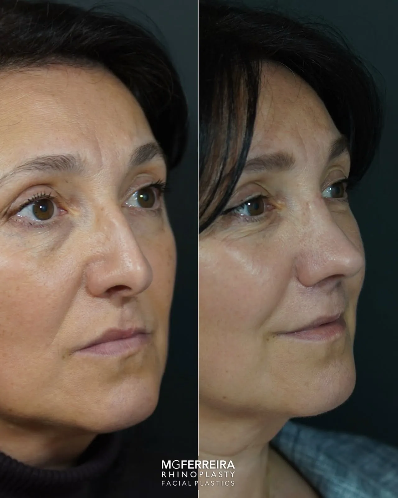 Antes e depois de rinoplastia em paciente com fissura, vista oblíqua direita