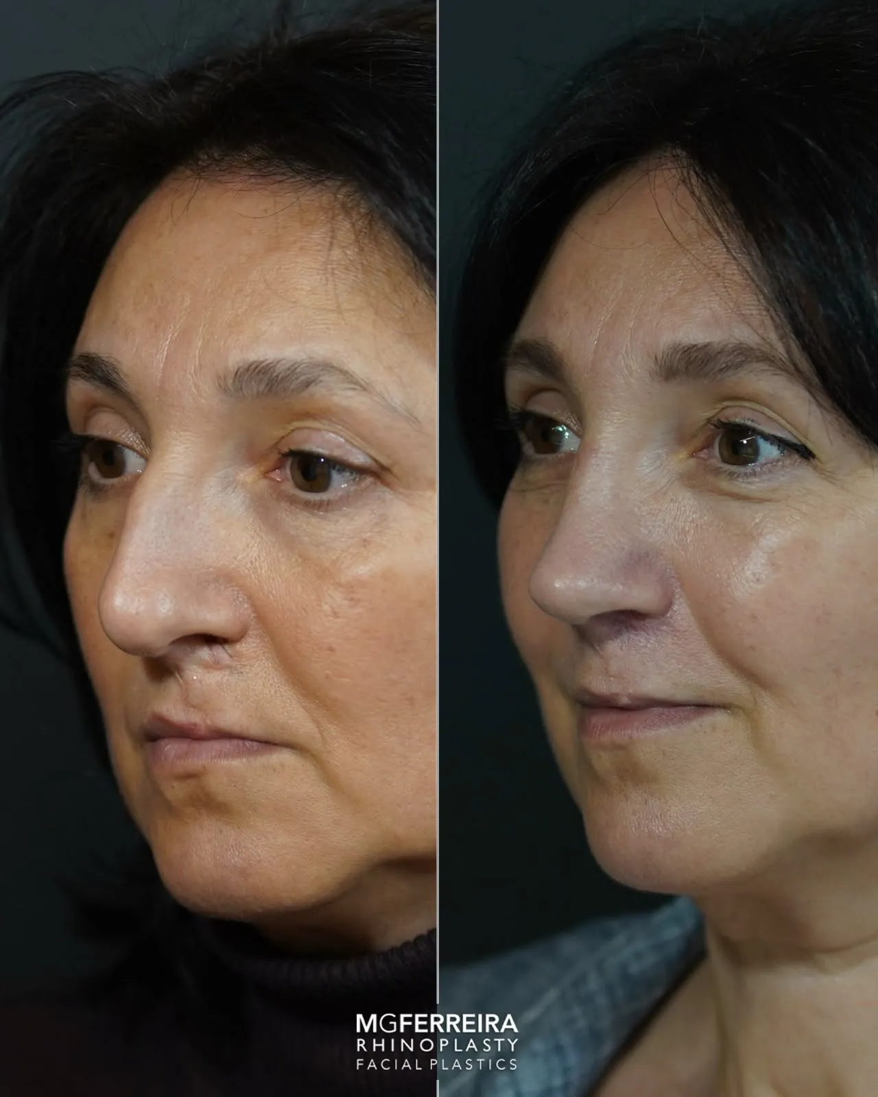 Antes e depois de rinoplastia em paciente com fissura, vista oblíqua esquerda