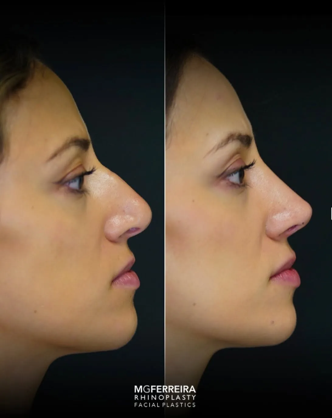 Rinoplastia em pele grossa: evolução aos três meses, perfil