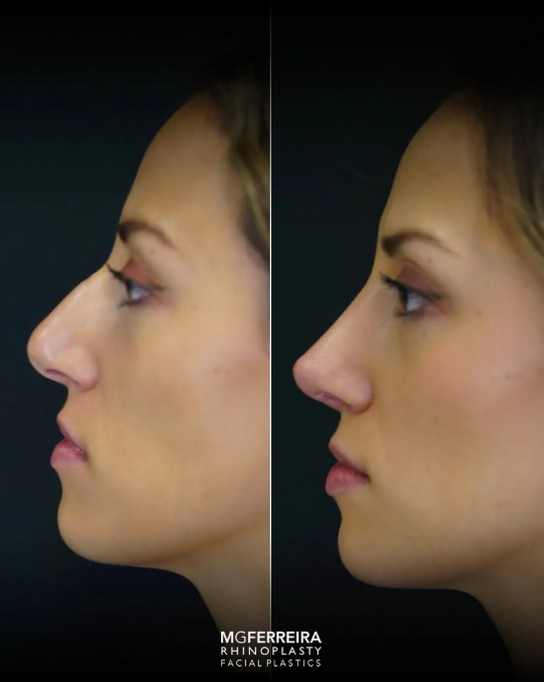Rinoplastia em pele grossa: evolução aos três meses, perfil oposto
