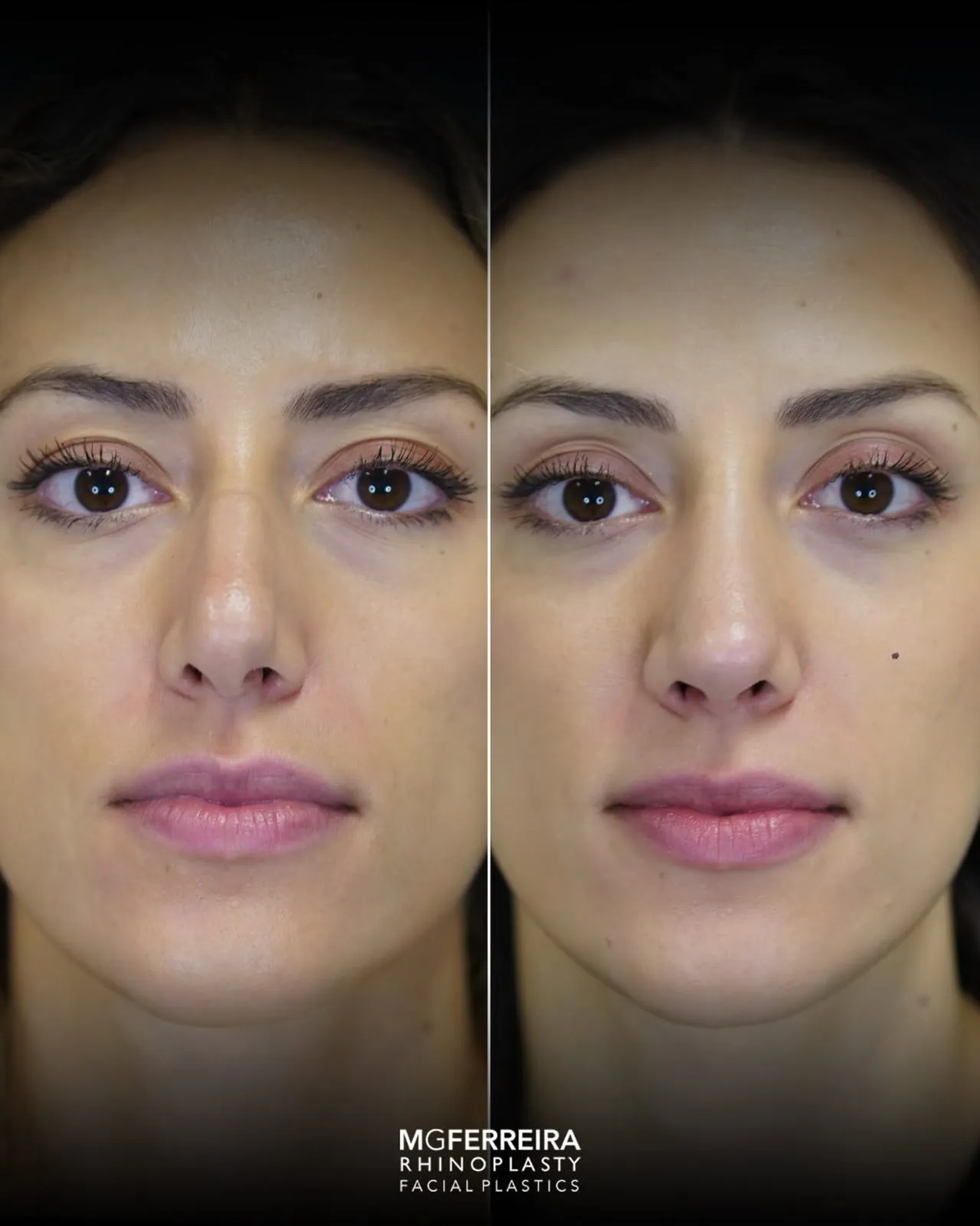 Rinoplastia em pele grossa: evolução aos três meses, vista frontal