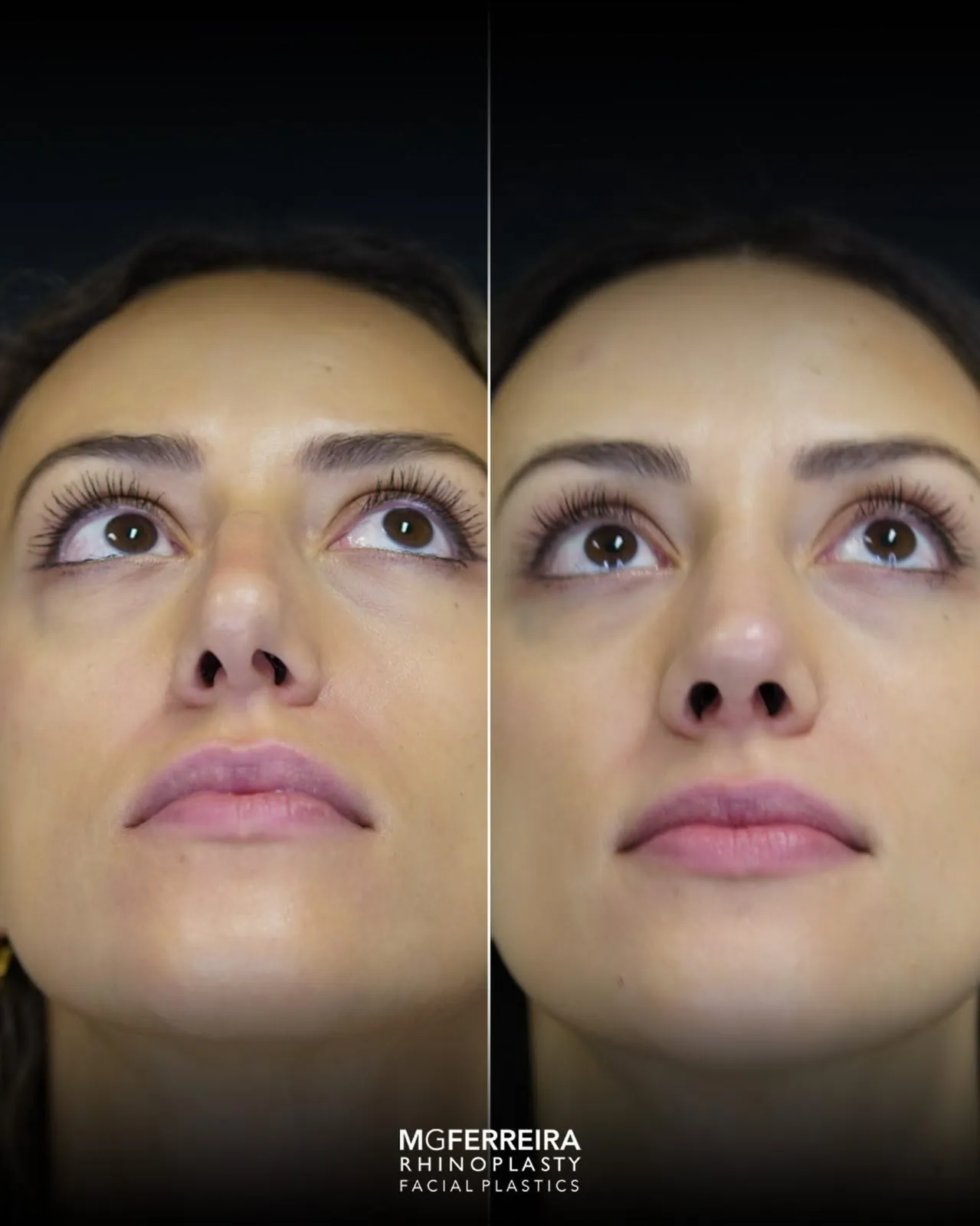 Rinoplastia em pele grossa: evolução aos três meses, vista inferior