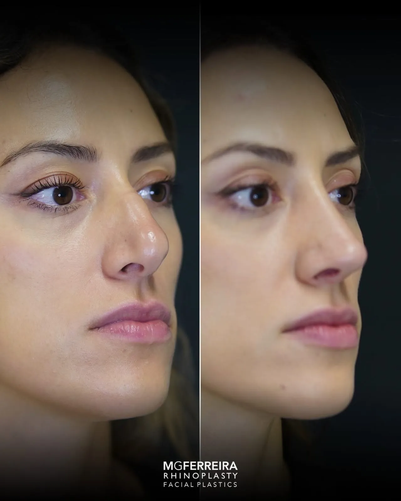 Rinoplastia em pele grossa: evolução aos três meses, vista oblíqua