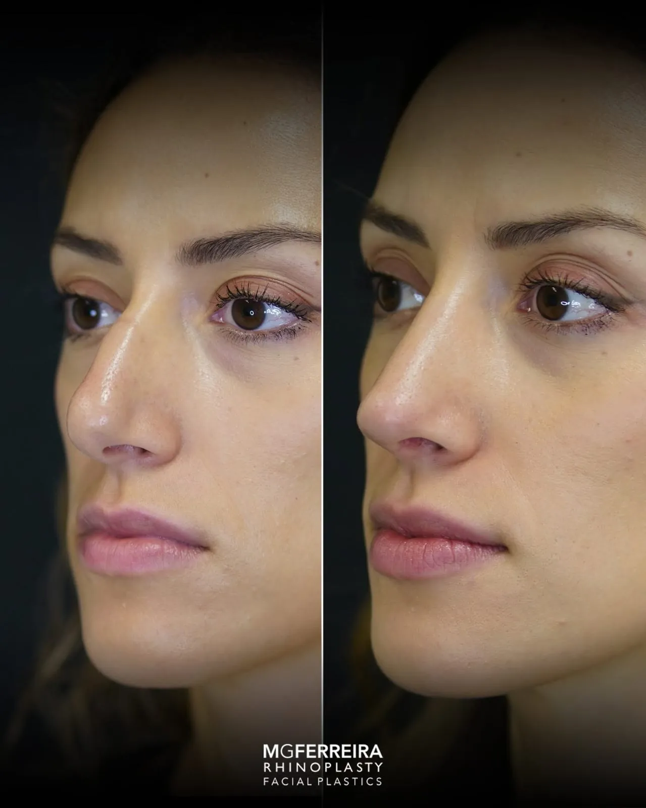 Rinoplastia em pele grossa: evolução aos três meses, vista oblíqua oposta