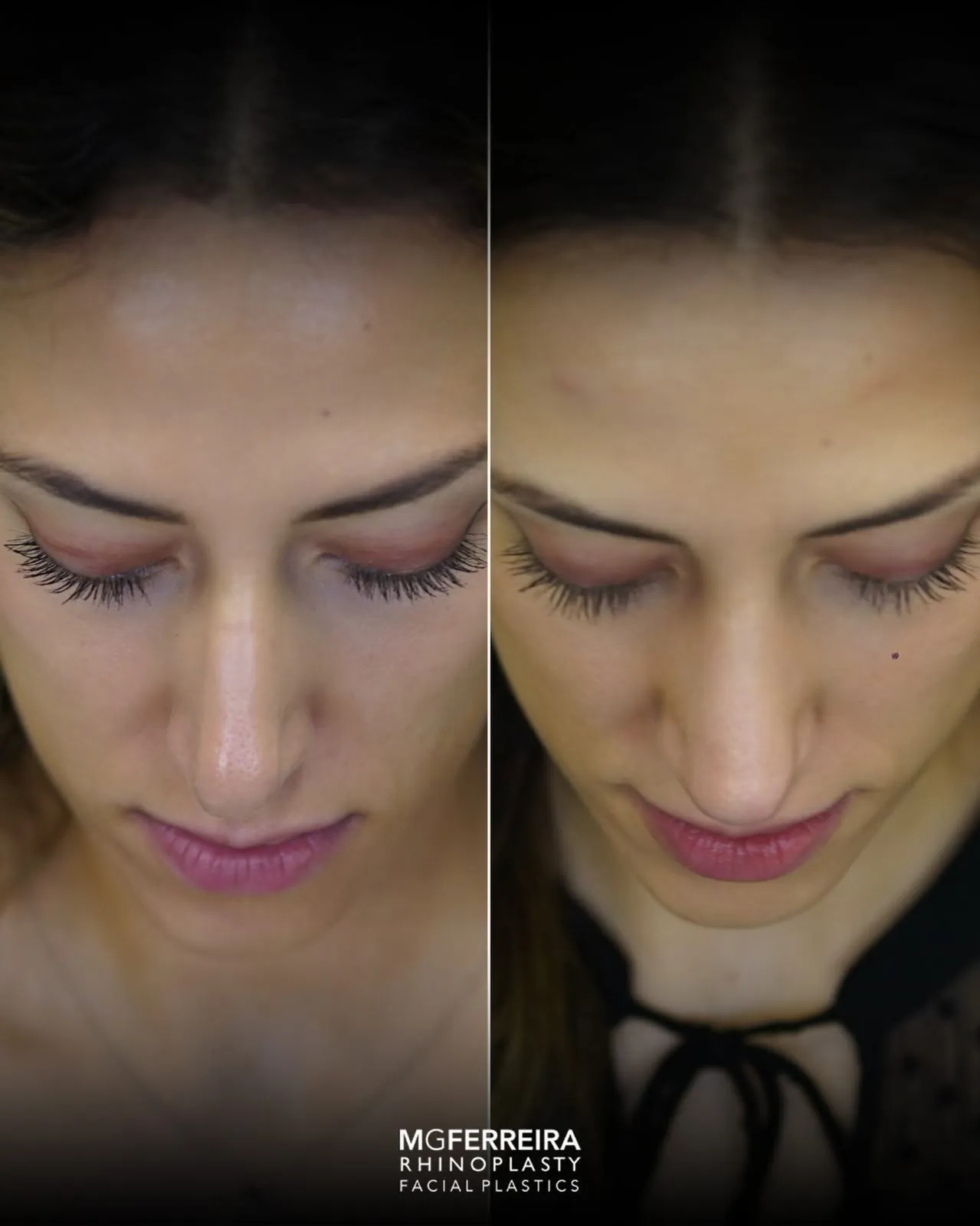 Rinoplastia em pele grossa: evolução aos três meses, vista superior