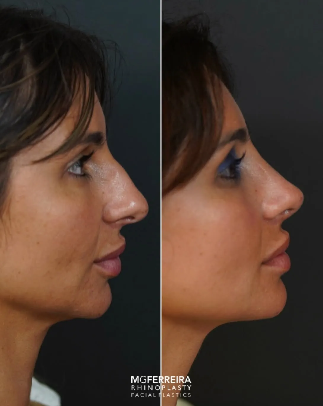 Rinoplastia em pele grossa: giba e ponta caída, perfil