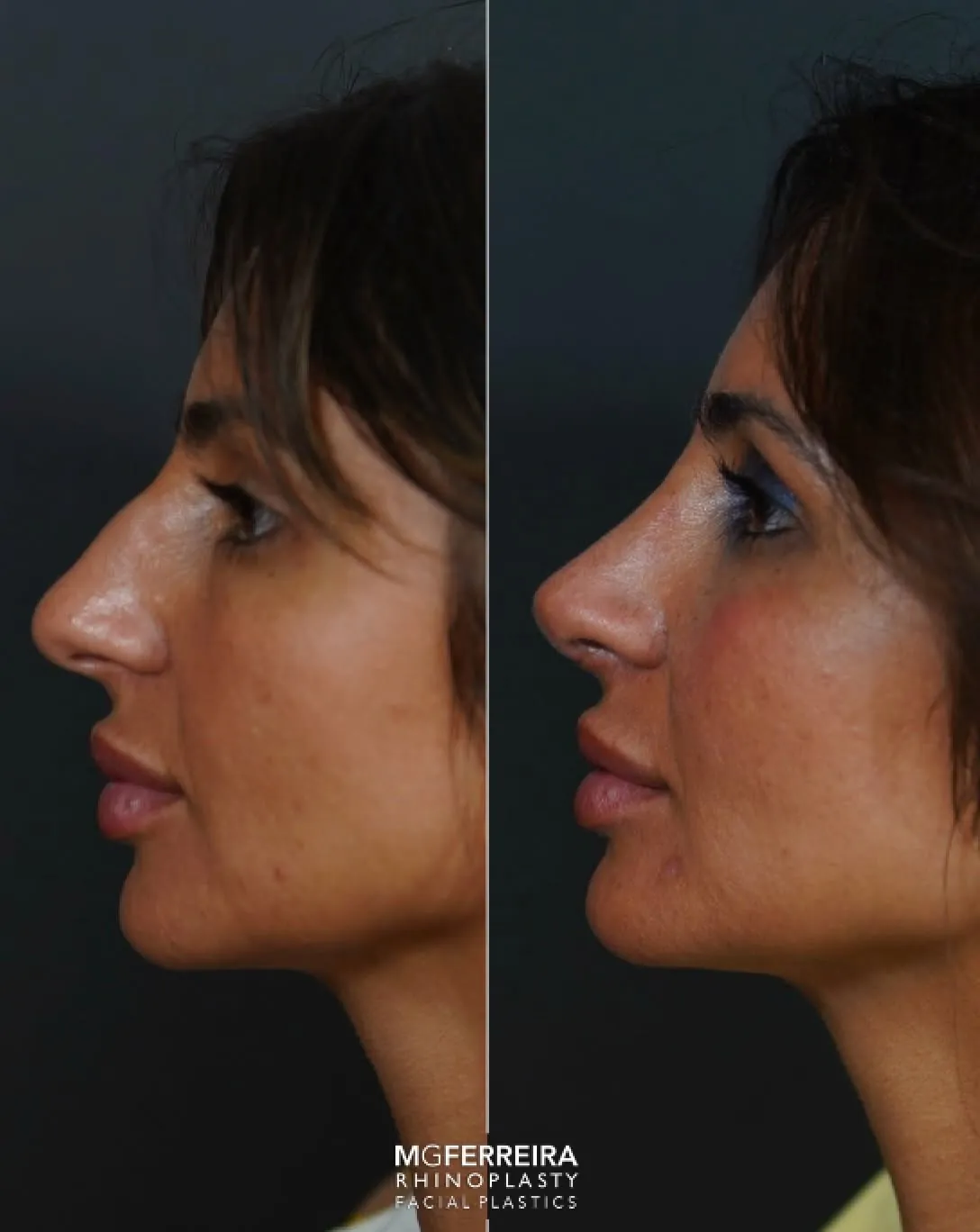 Rinoplastia em pele grossa: giba e ponta caída, perfil oposto