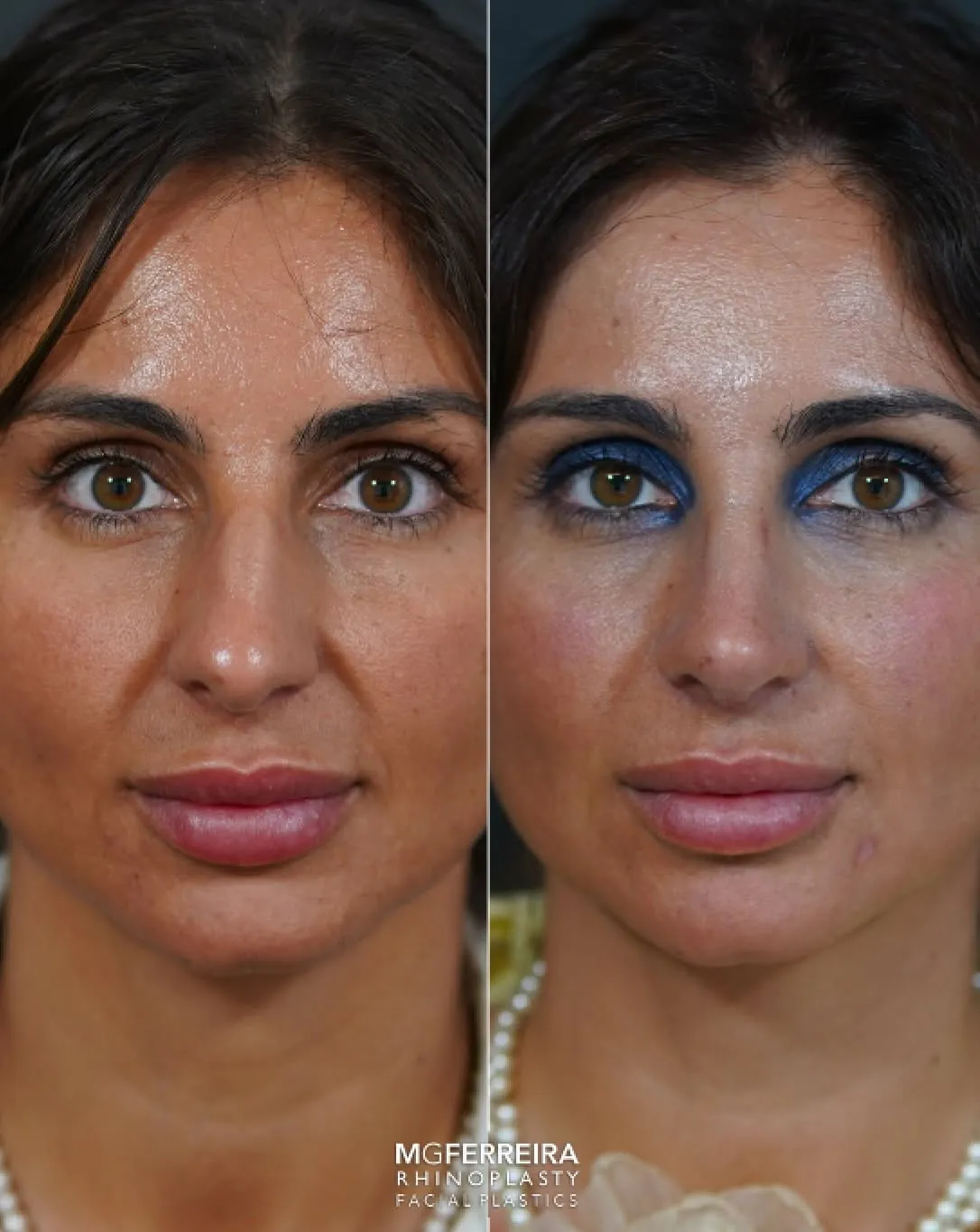 Rinoplastia em pele grossa: giba e ponta caída, vista frontal