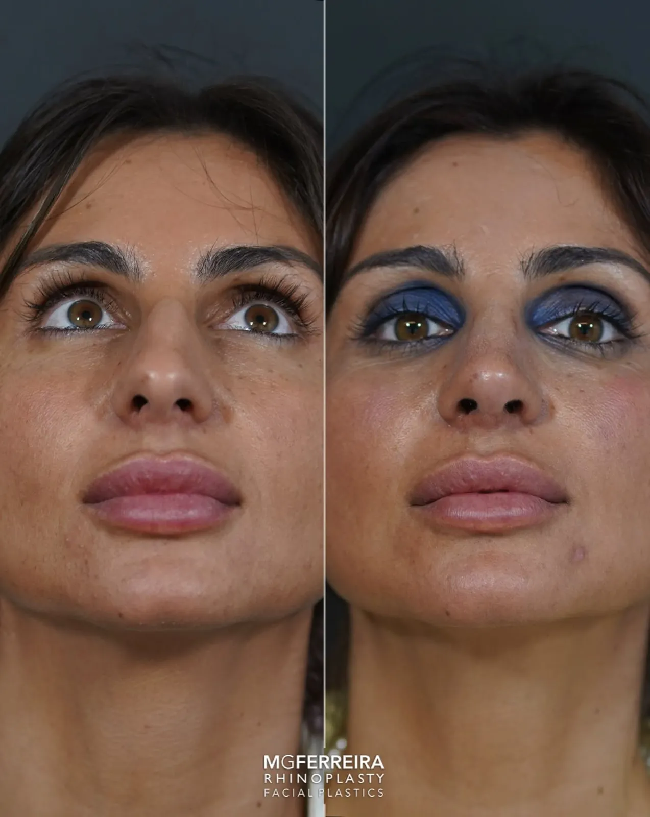 Rinoplastia em pele grossa: giba e ponta caída, vista inferior