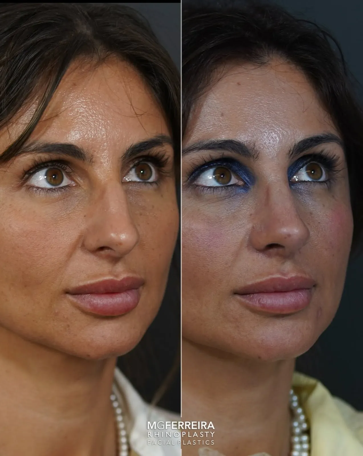Rinoplastia em pele grossa: giba e ponta caída, vista oblíqua