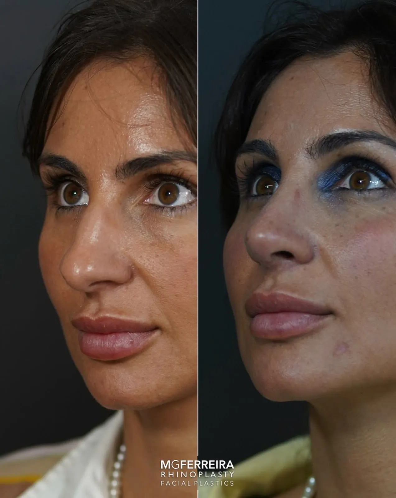 Rinoplastia em pele grossa: giba e ponta caída, vista oblíqua oposta