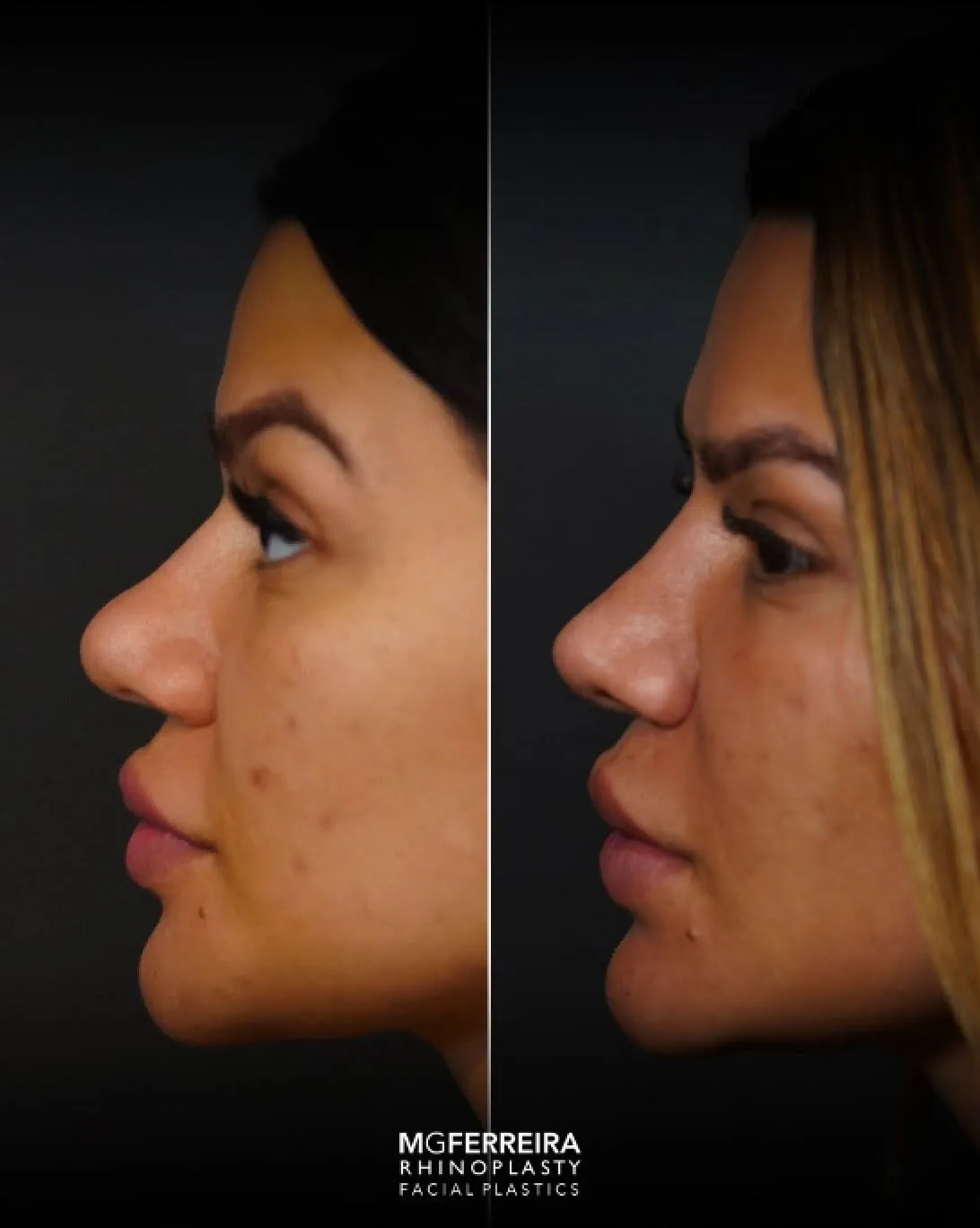 Rinoplastia em Riade: dorso baixo e pele grossa, perfil