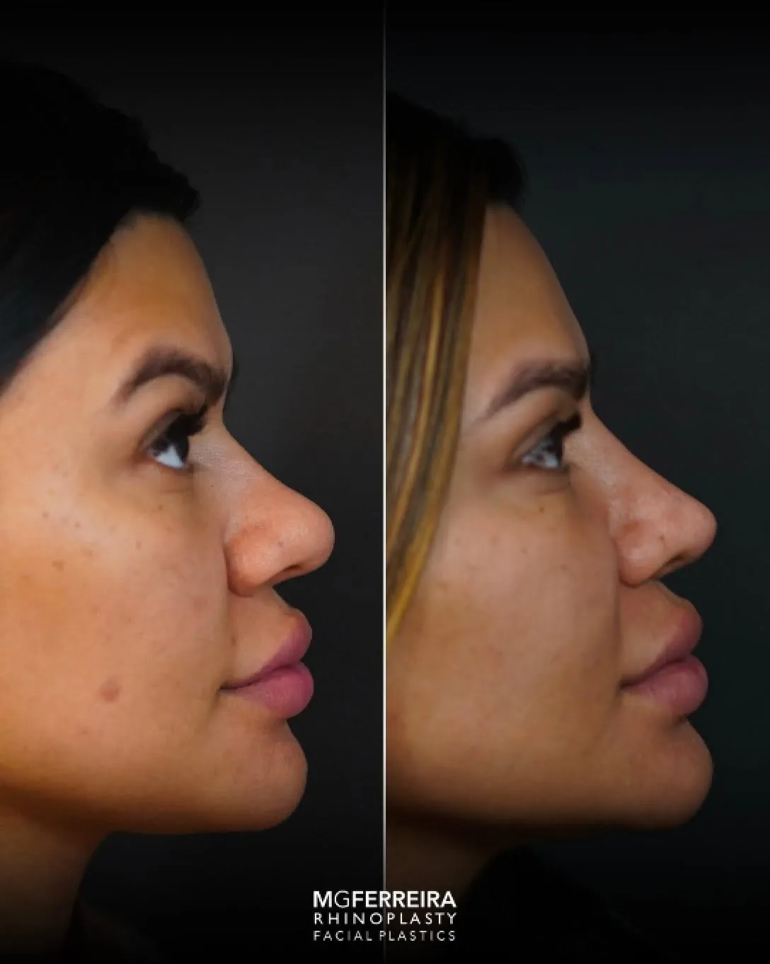 Rinoplastia em Riade: dorso baixo e pele grossa, perfil oposto