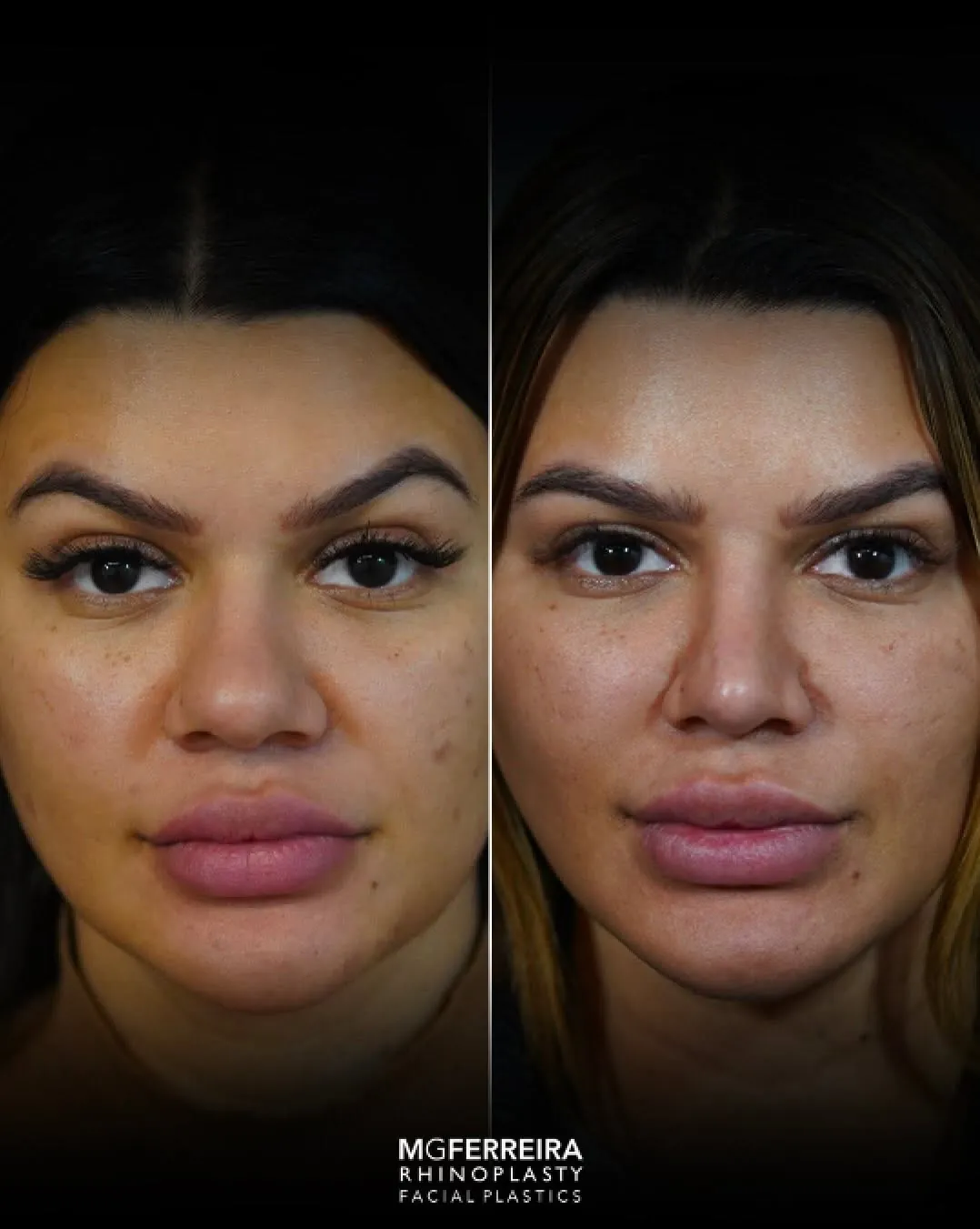 Rinoplastia em Riade: dorso baixo e pele grossa, vista frontal