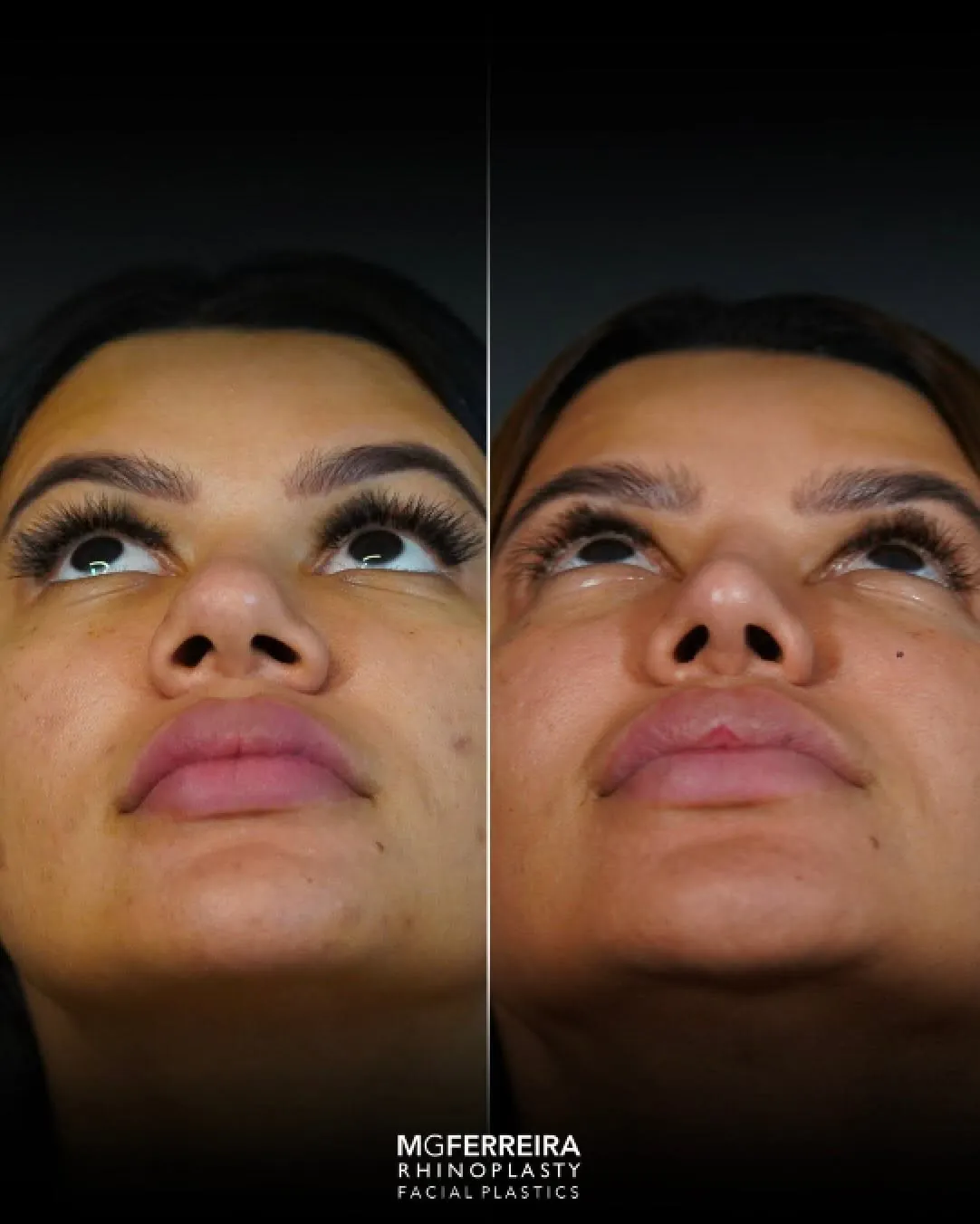 Rinoplastia em Riade: dorso baixo e pele grossa, vista inferior