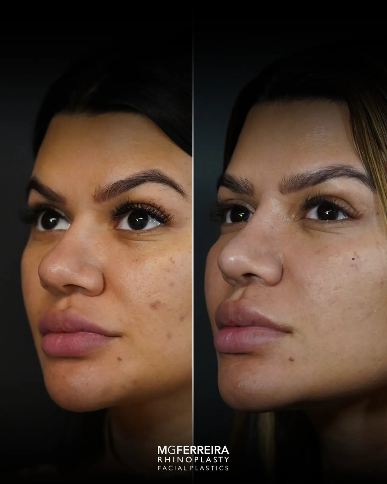 Rinoplastia em Riade: dorso baixo e pele grossa, vista oblíqua