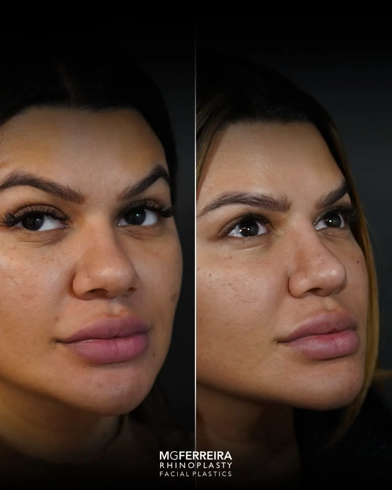 Rinoplastia em Riade: dorso baixo e pele grossa, vista oblíqua oposta
