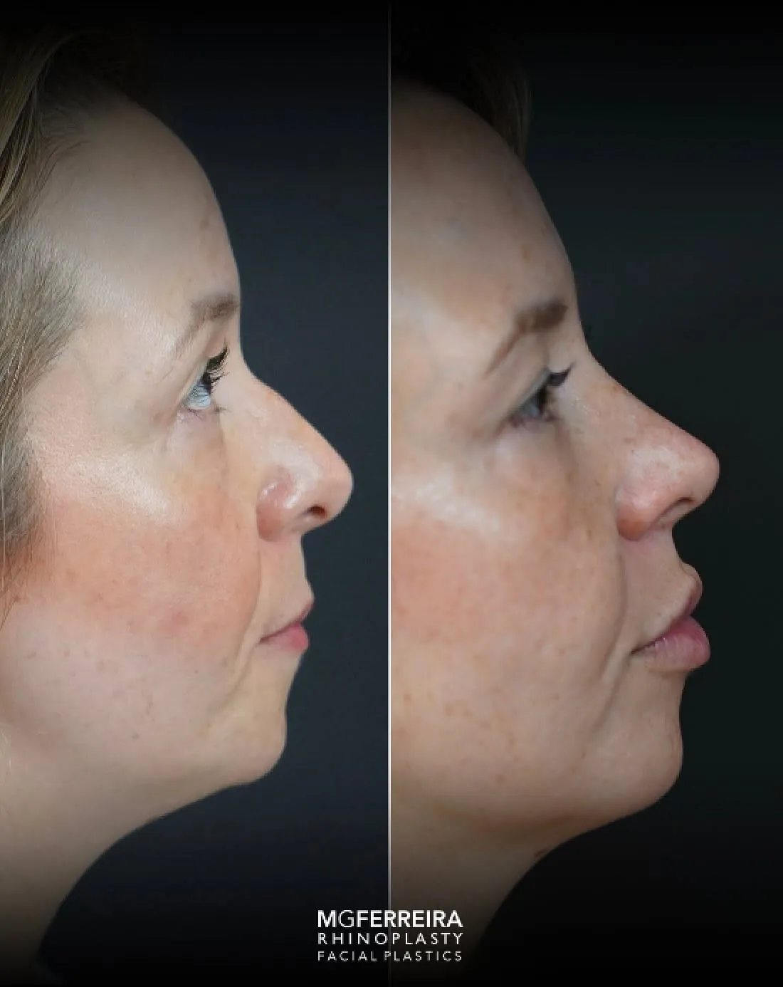 Rinoplastia em Riade: nariz curto e raiz nasal baixa, perfil