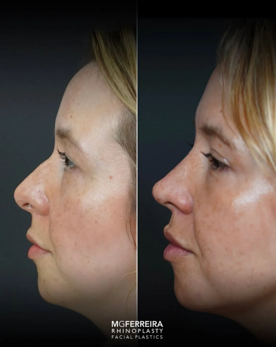 Rinoplastia em Riade: nariz curto e raiz nasal baixa, perfil oposto