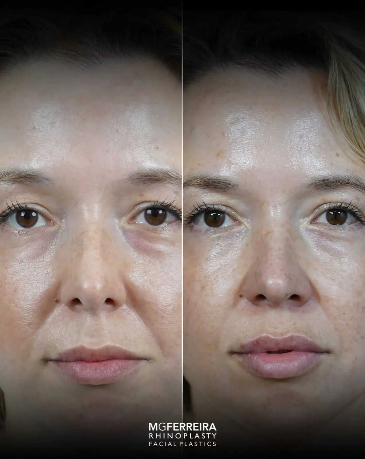 Rinoplastia em Riade: nariz curto e raiz nasal baixa, vista frontal