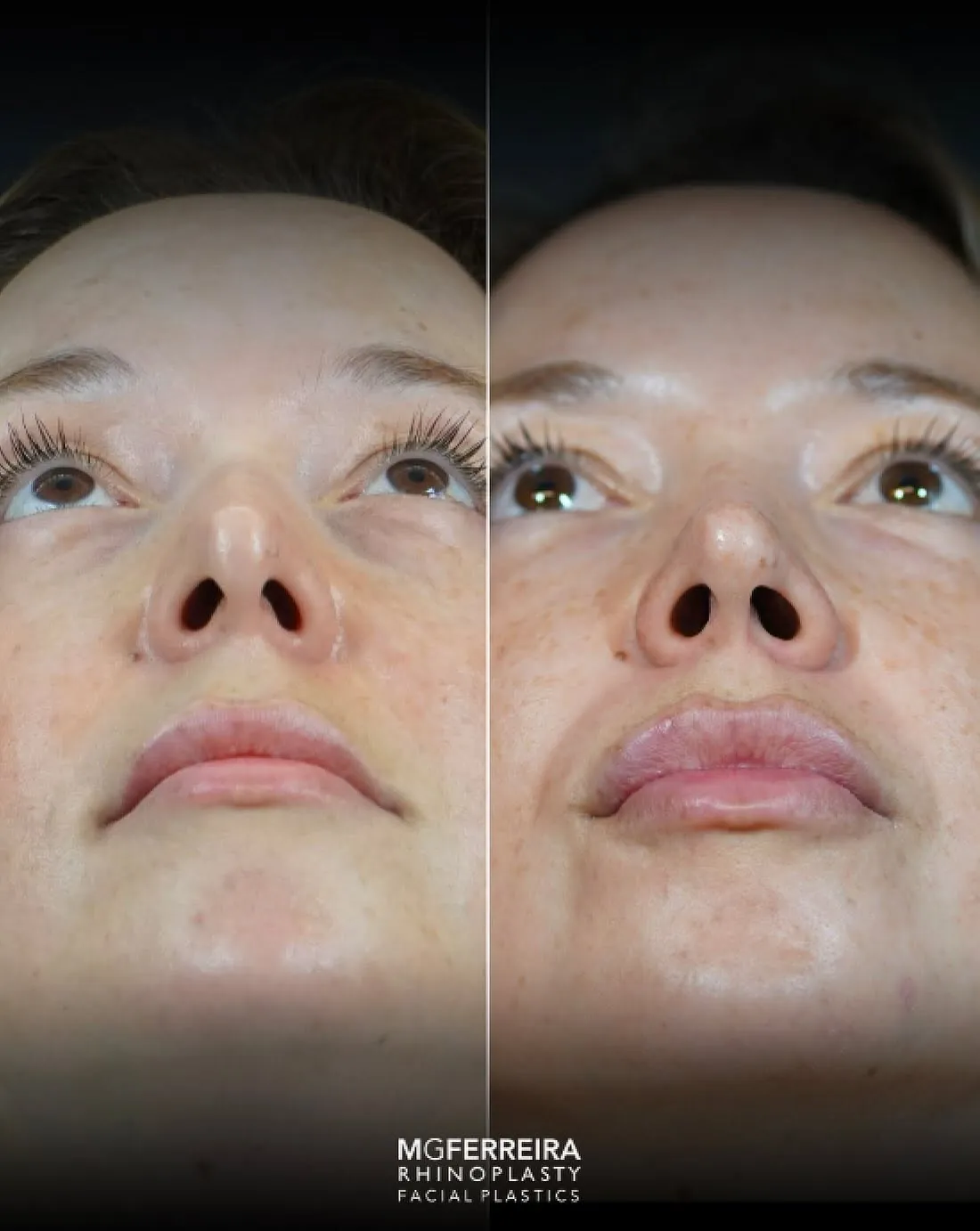Rinoplastia em Riade: nariz curto e raiz nasal baixa, vista inferior