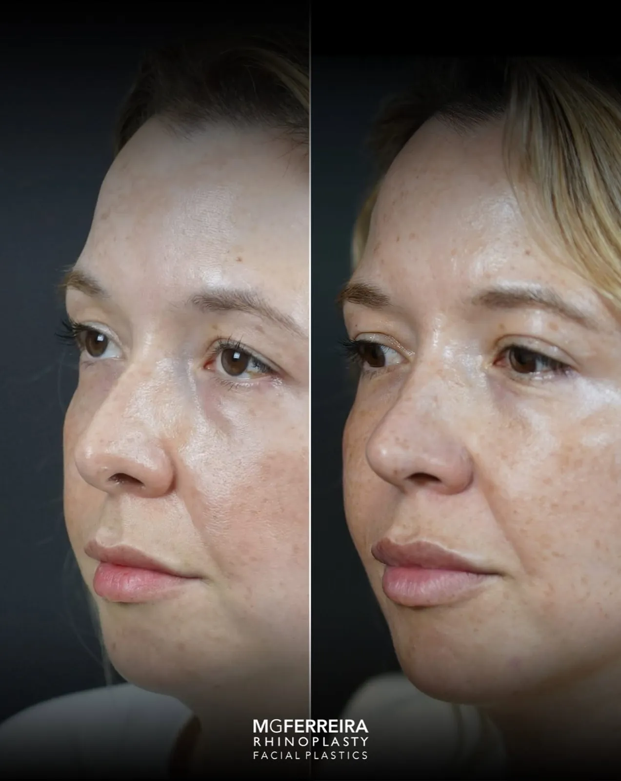 Rinoplastia em Riade: nariz curto e raiz nasal baixa, vista oblíqua