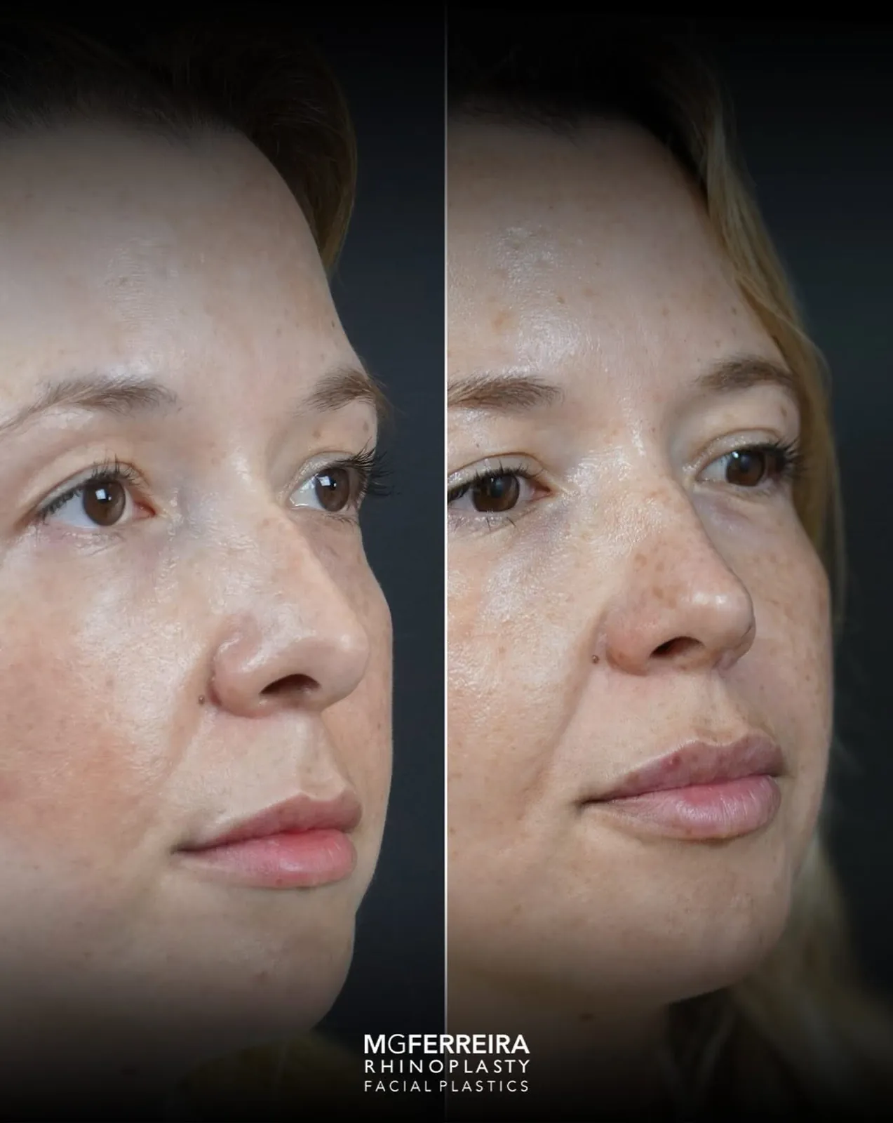 Rinoplastia em Riade: nariz curto e raiz nasal baixa, vista oblíqua oposta