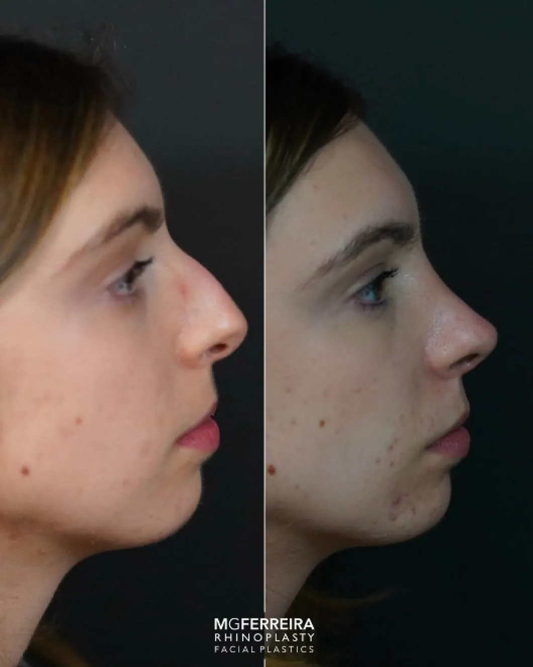 Rinoplastia: giba acentuada e definição da ponta, perfil