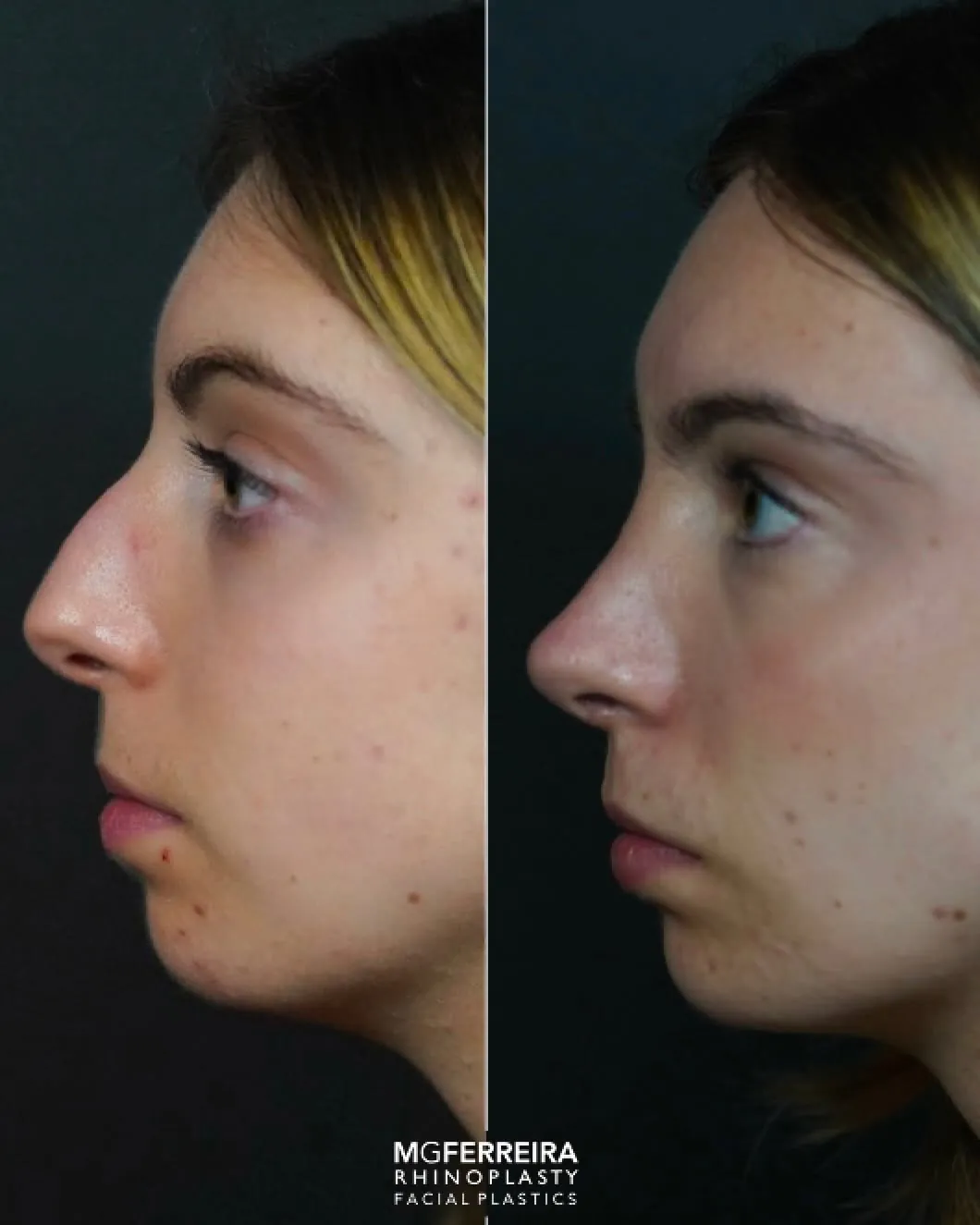 Rinoplastia: giba acentuada e definição da ponta, perfil oposto