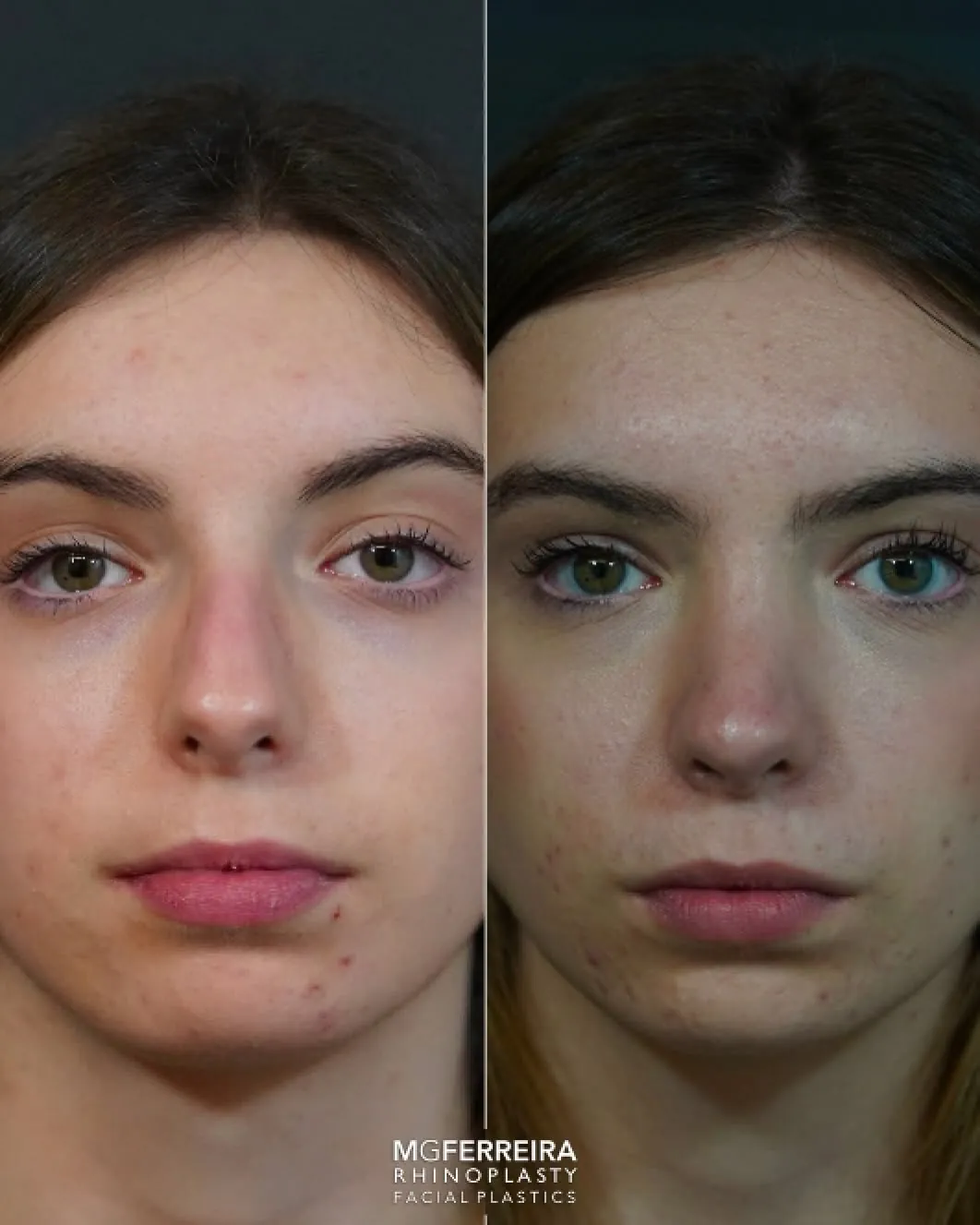 Rinoplastia: giba acentuada e definição da ponta, vista frontal
