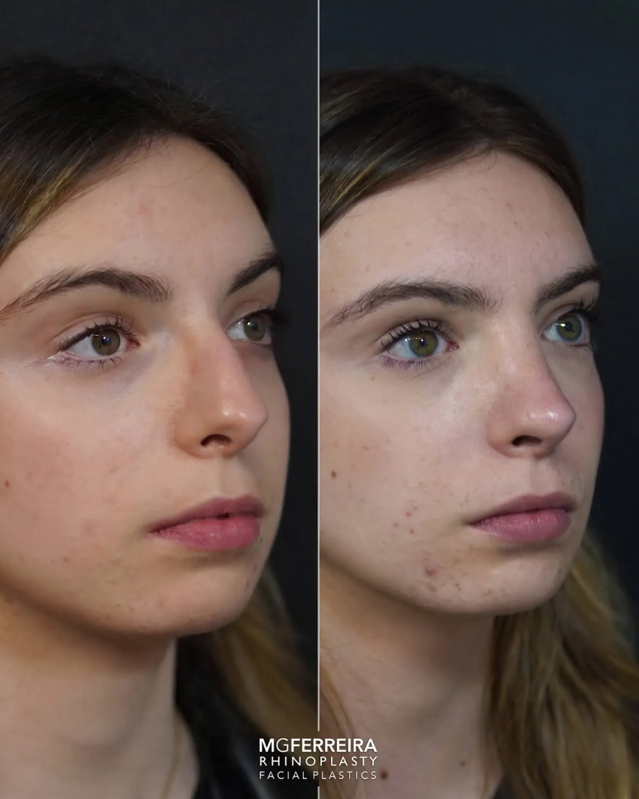 Rinoplastia: giba acentuada e definição da ponta, vista oblíqua