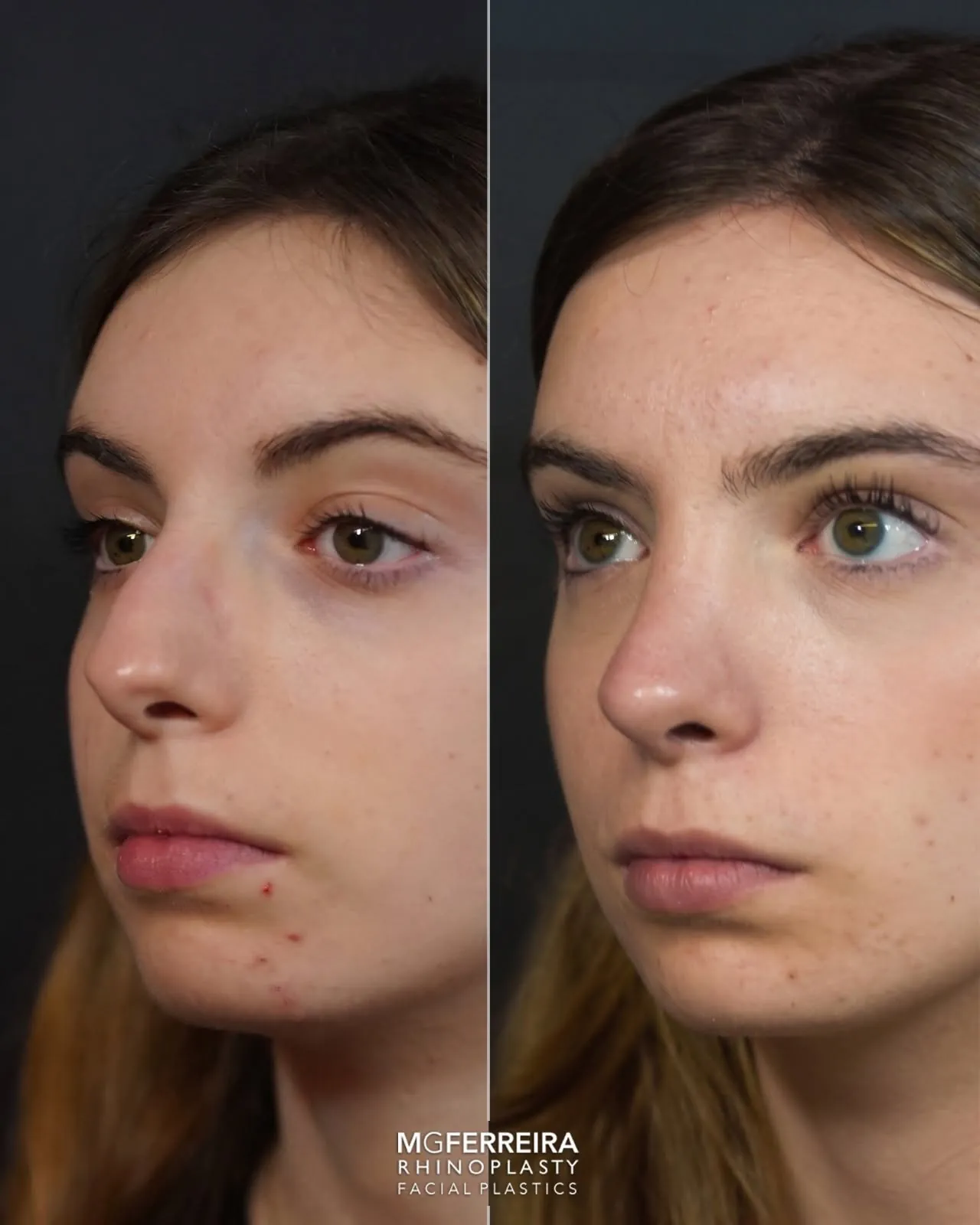 Rinoplastia: giba acentuada e definição da ponta, vista oblíqua oposta