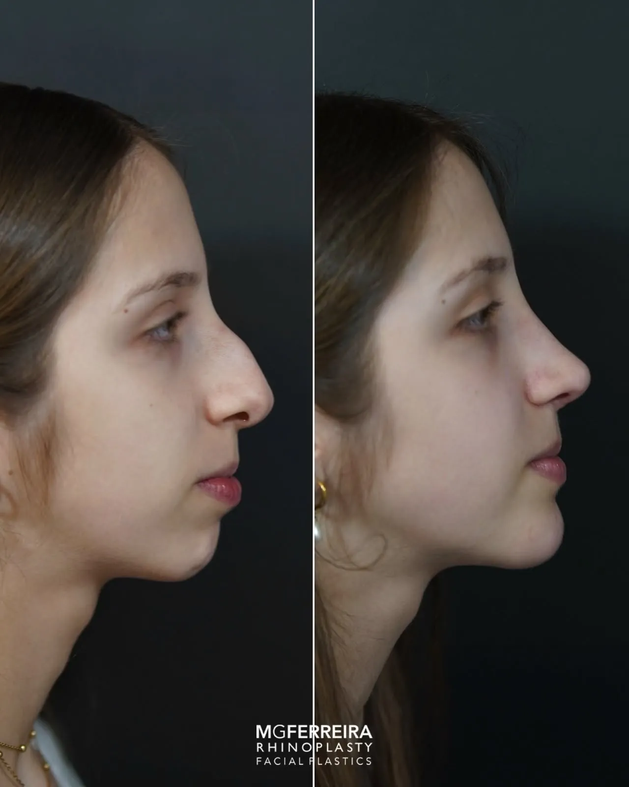 Rinoplastia: giba acentuada num perfil com retrognatia, perfil