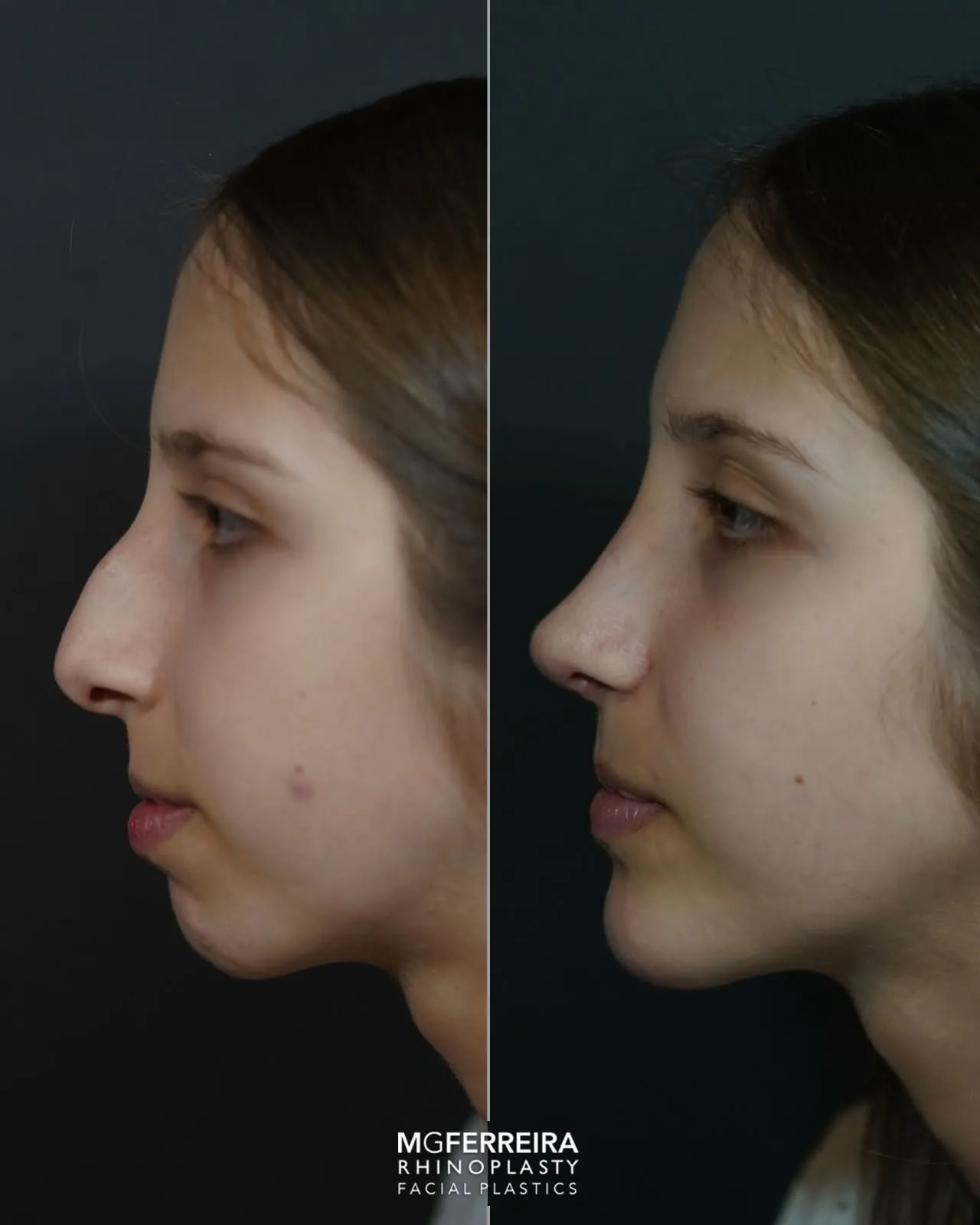 Rinoplastia: giba acentuada num perfil com retrognatia, perfil oposto