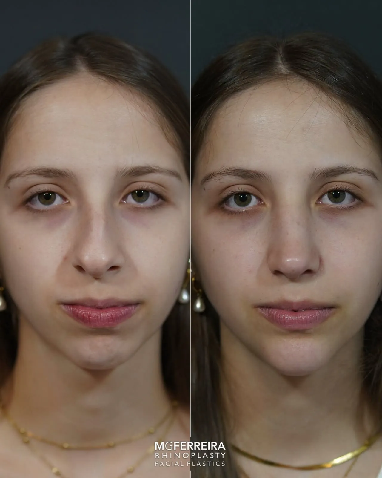 Rinoplastia: giba acentuada num perfil com retrognatia, vista frontal