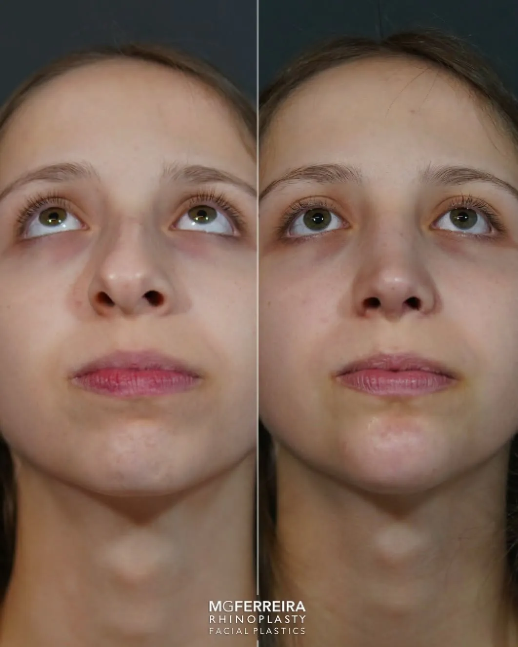 Rinoplastia: giba acentuada num perfil com retrognatia, vista inferior