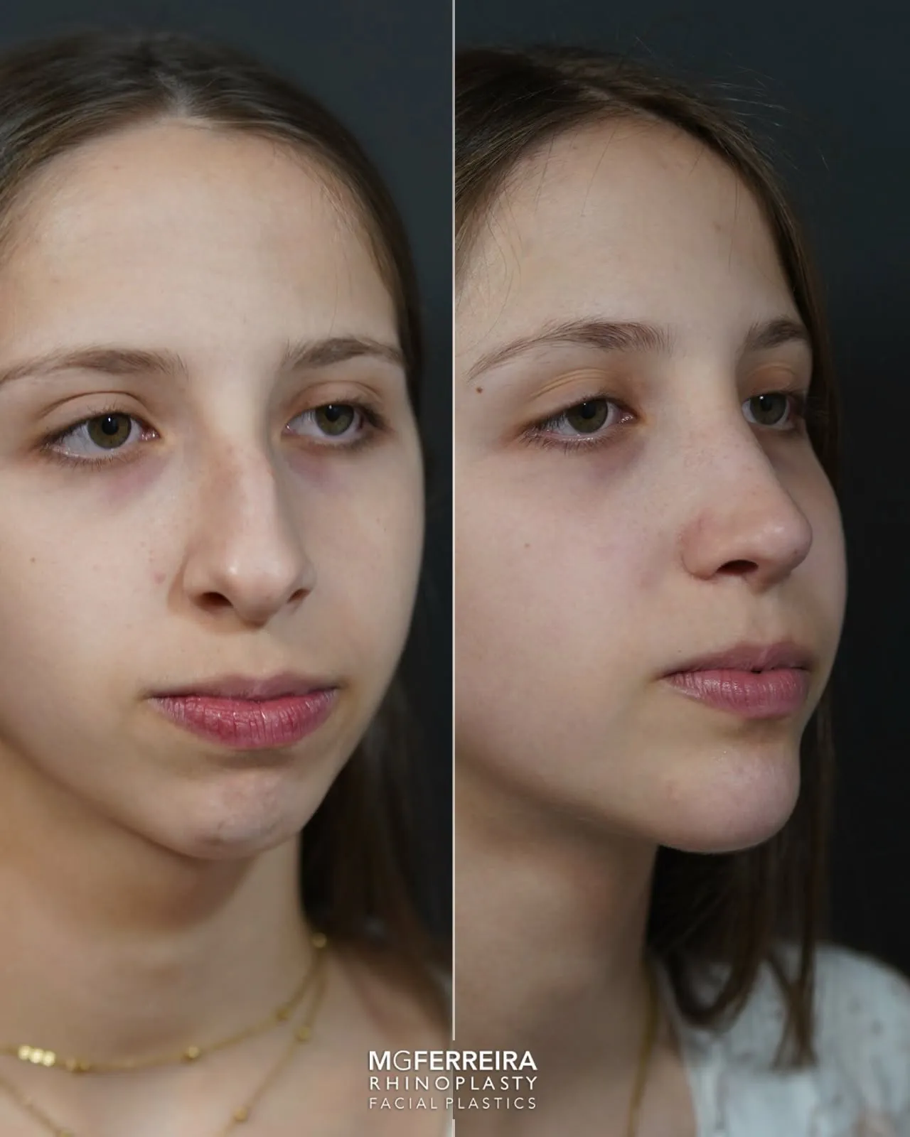 Rinoplastia: giba acentuada num perfil com retrognatia, vista oblíqua